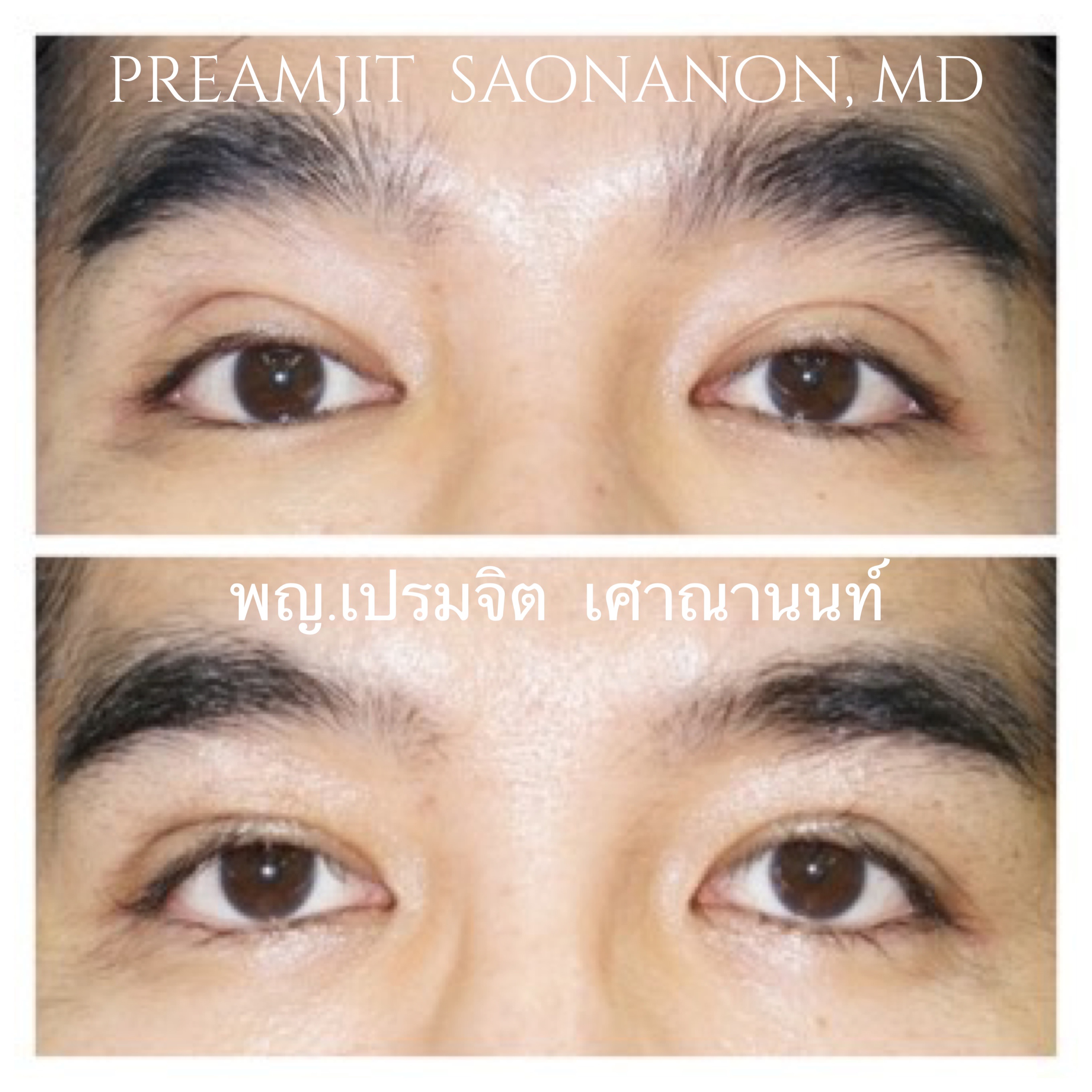 แก้ชั้นตาสูง