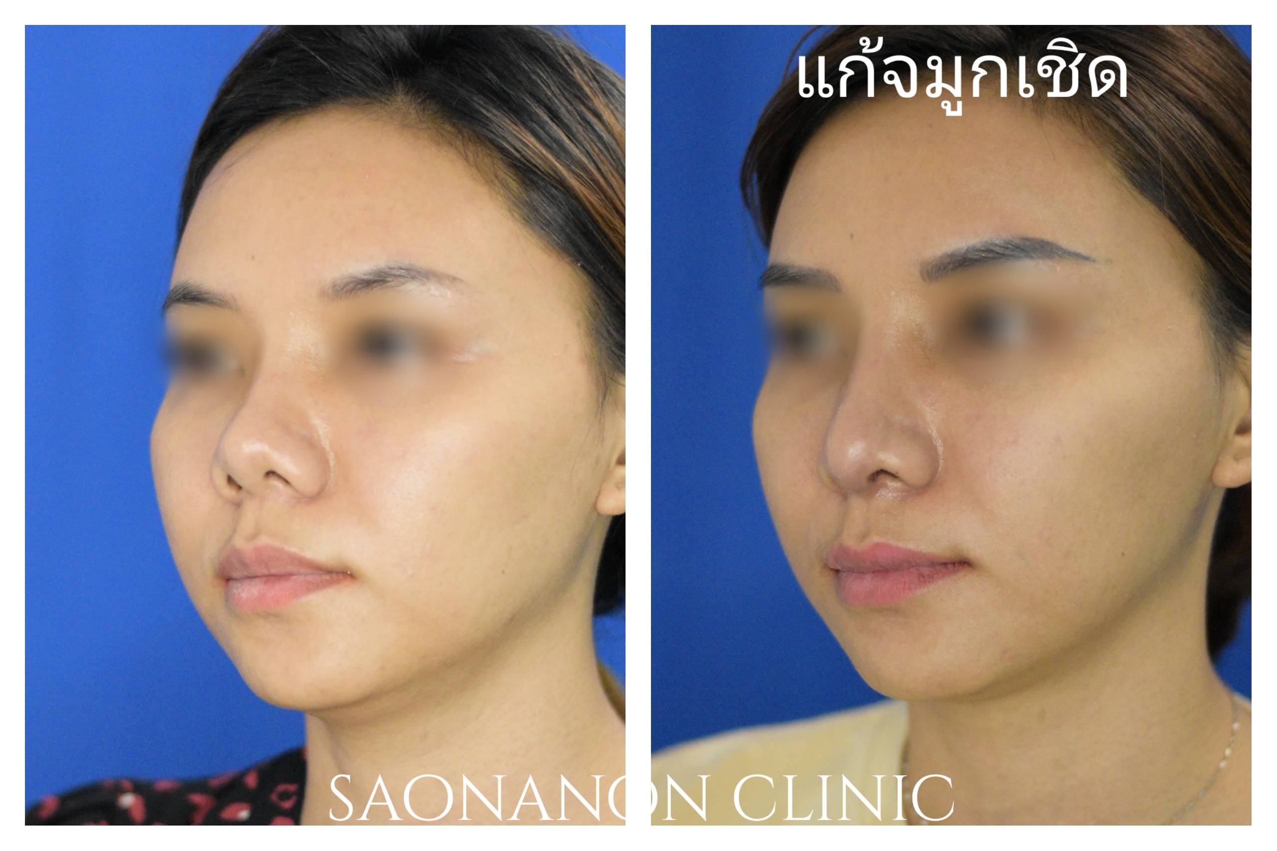 เพิ่มความยาวจมูก