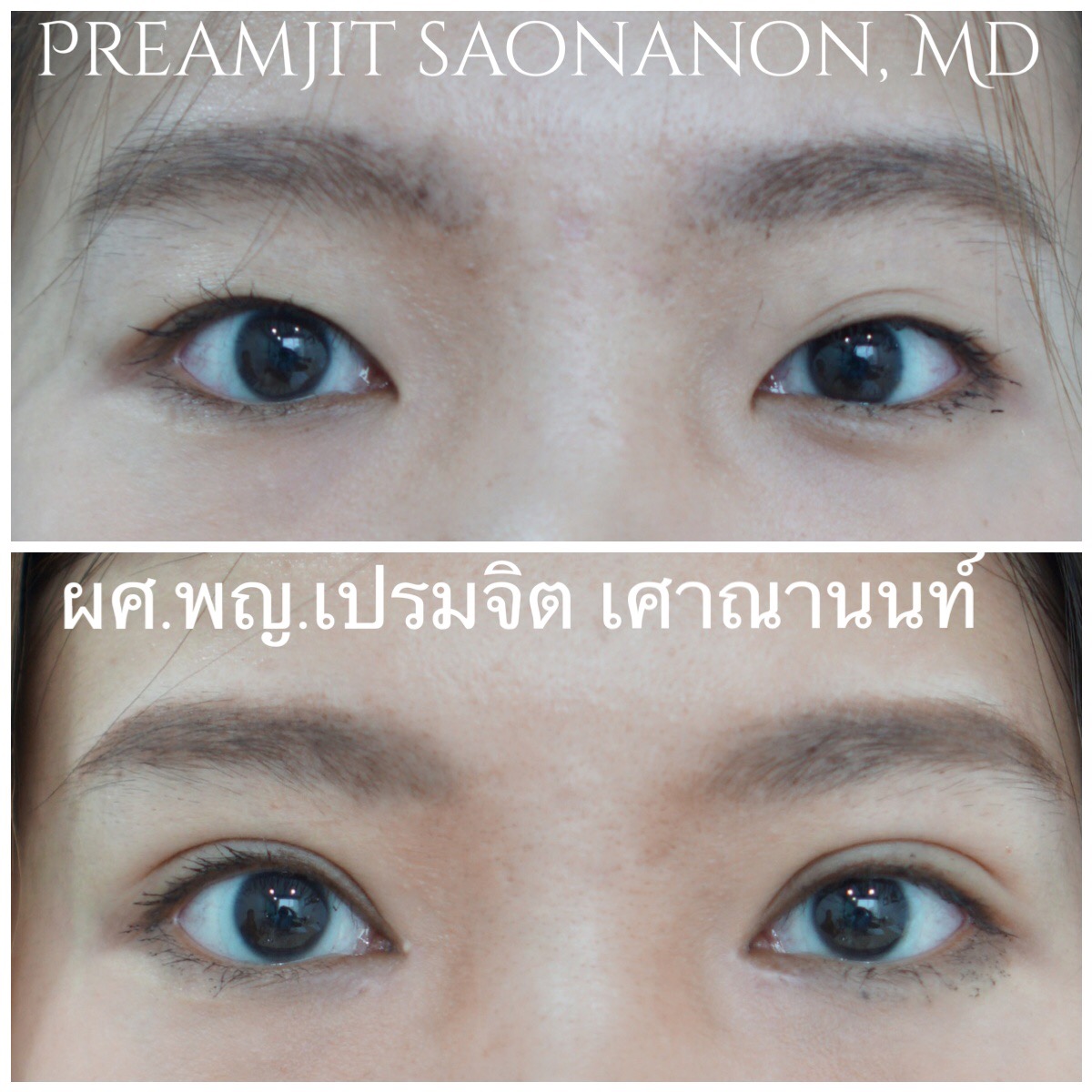 ตาสองชั้นแผลเล็ก เปิดหัวตา