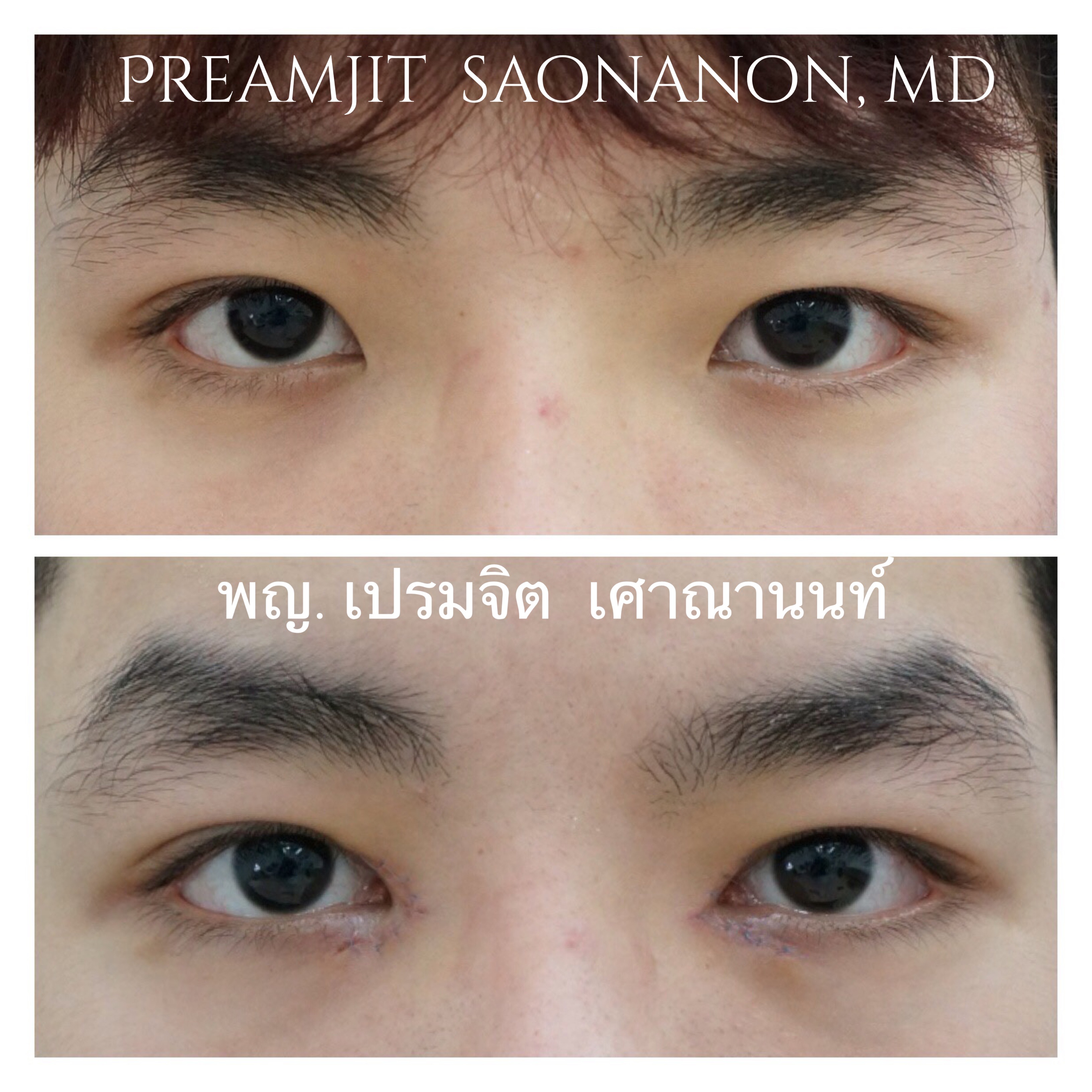 หลังเปิดหัวตาทันที