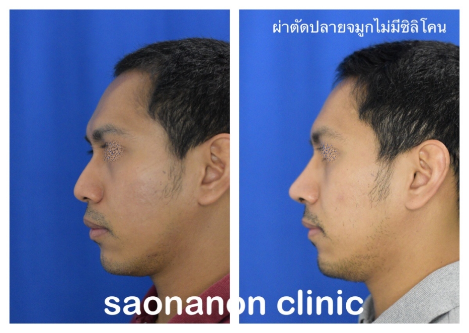 จมูกงุ้มแบบยาว