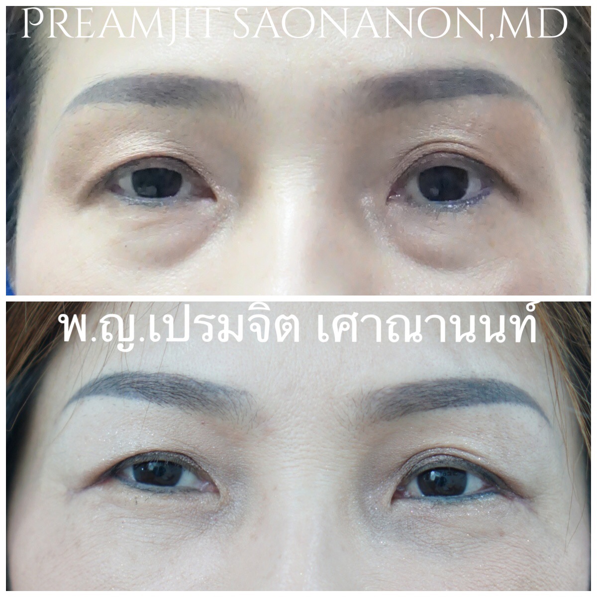 ผ่าตัดถุงใต้ตาซ้อนแผลและย้ายไขมัน