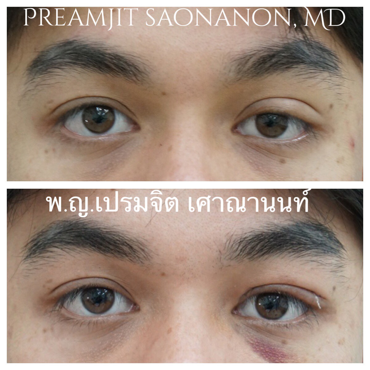 แก้หนังตาตกหนึ่งข้าง