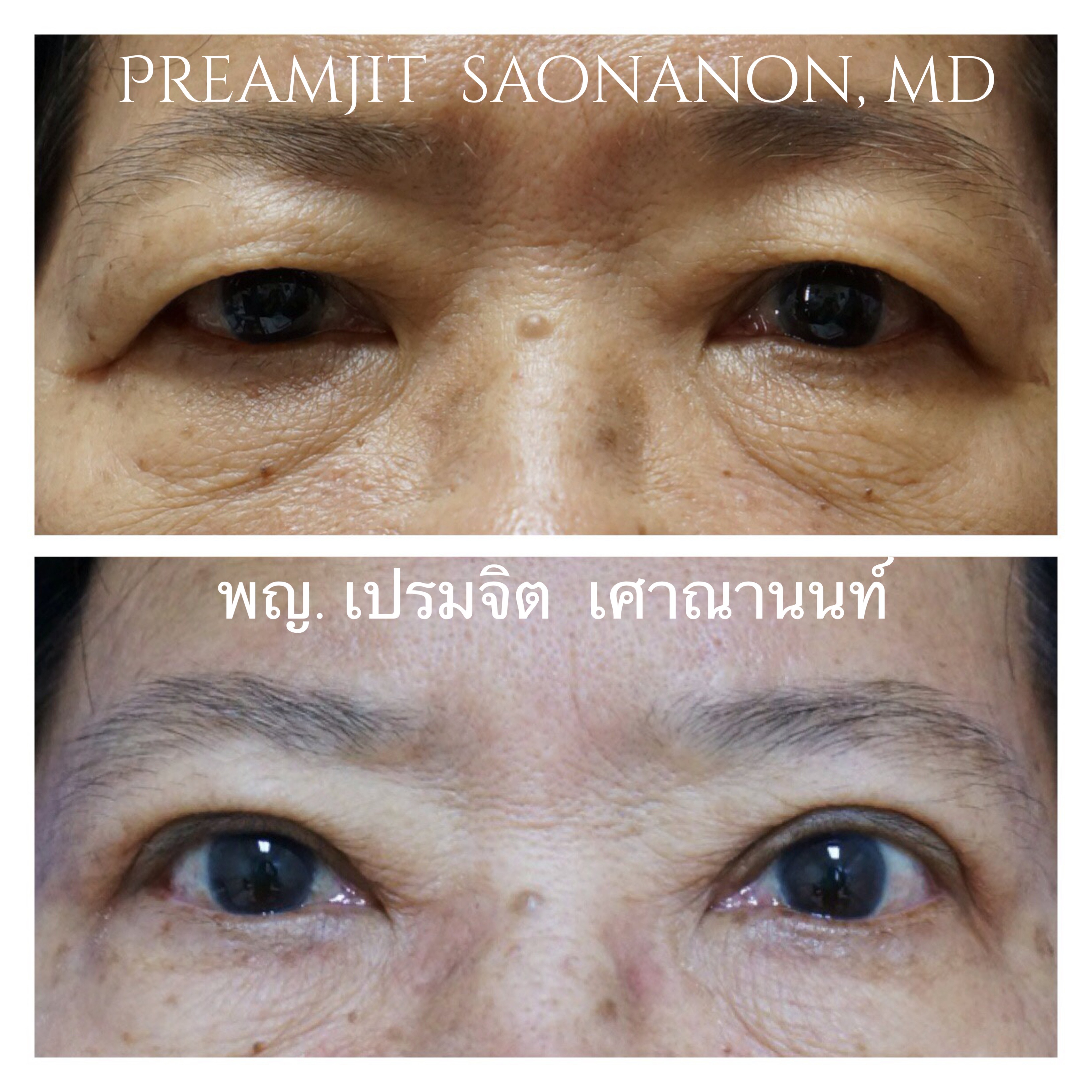 ผ่าดึงกล้ามเนื้อตาตัดหนังเกิน