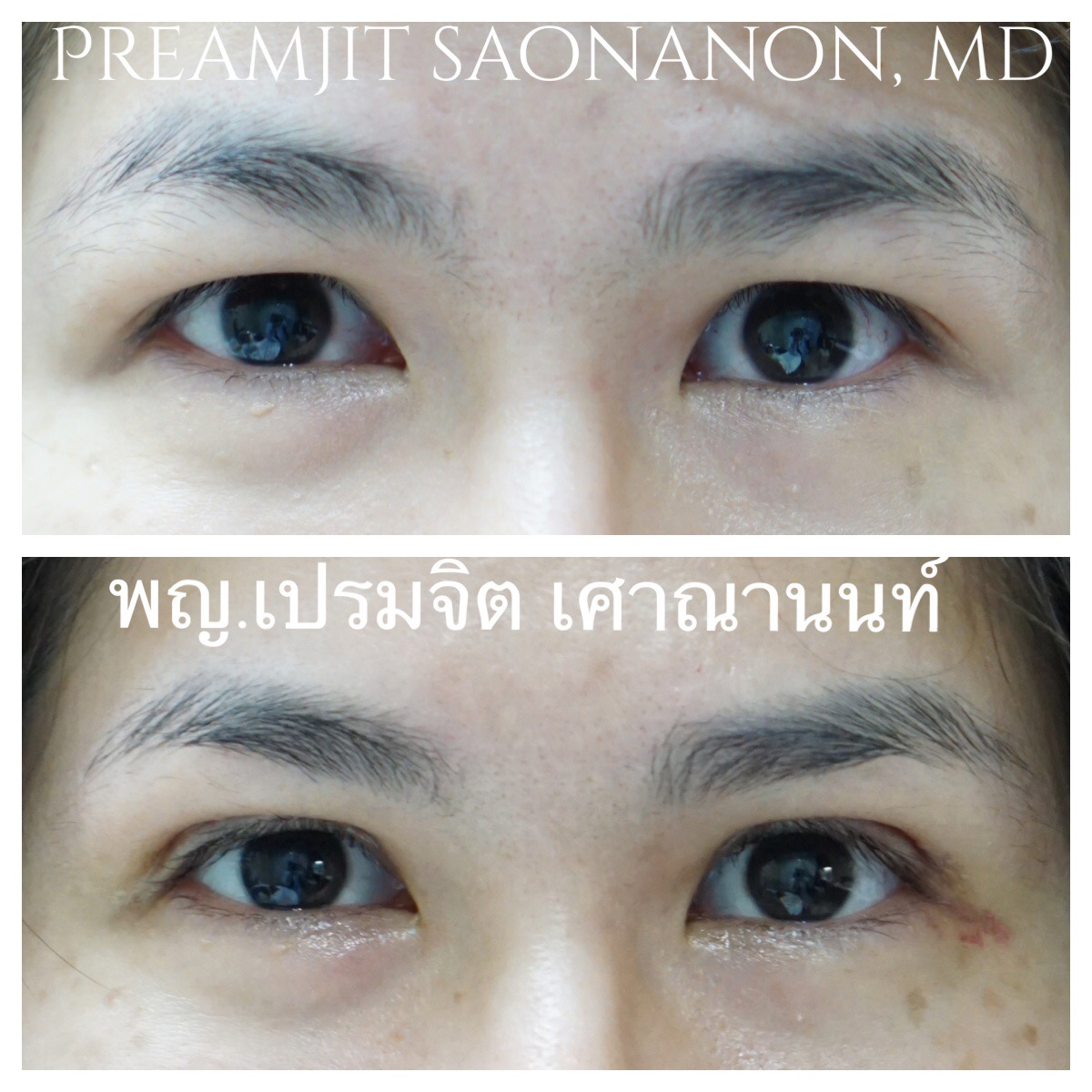 ผ่าตาสองชั้น