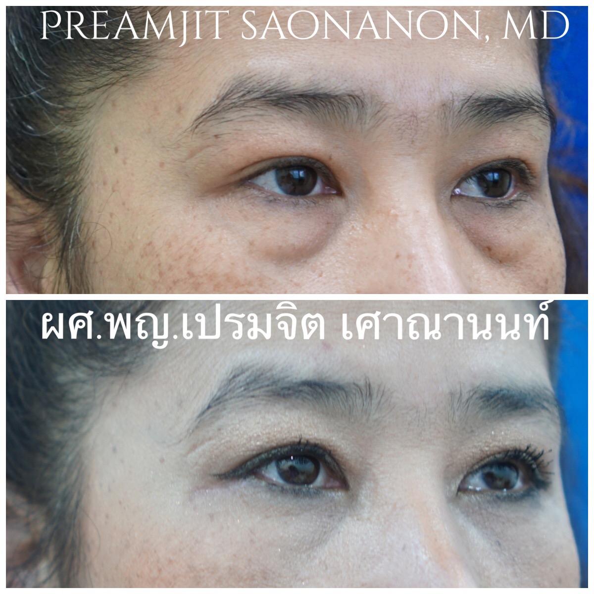 ผ่าตัดถุงใต้ตาและย้ายไขมันใต้ตา