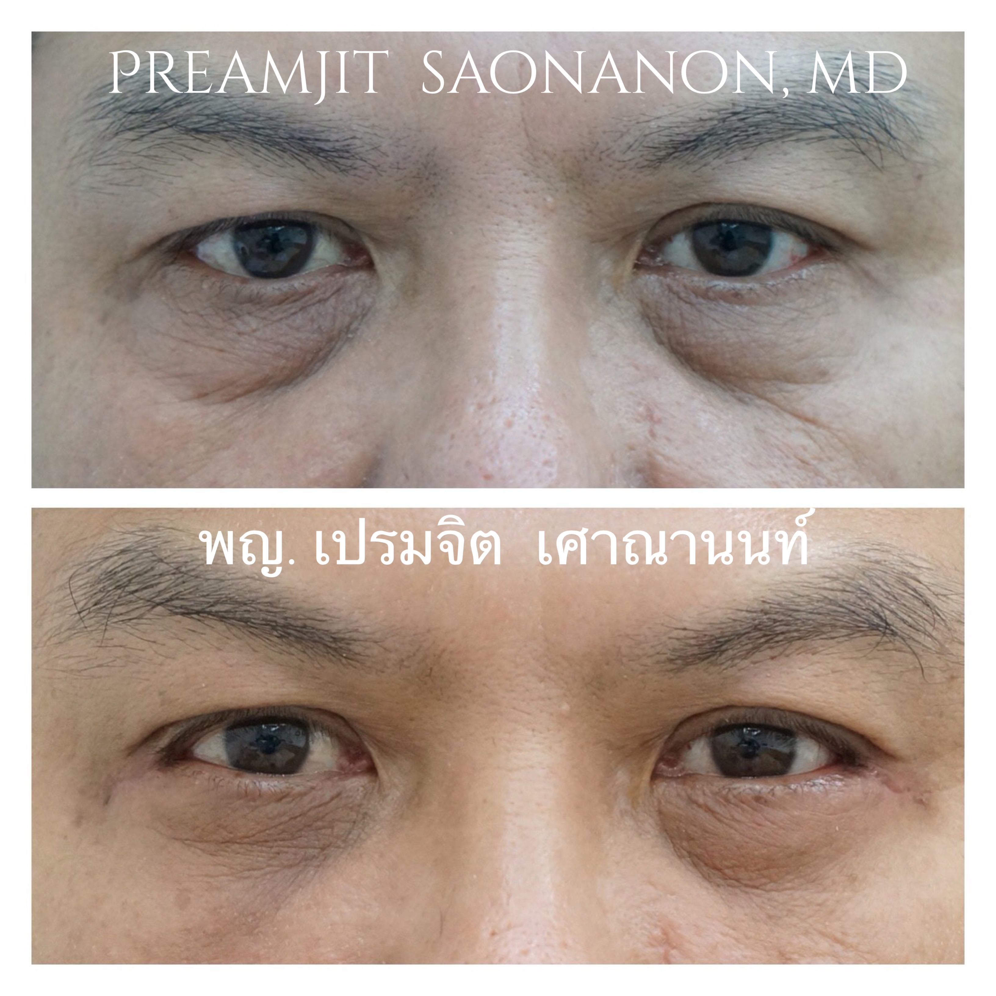 ผ่าตัดถุงใต้ตา