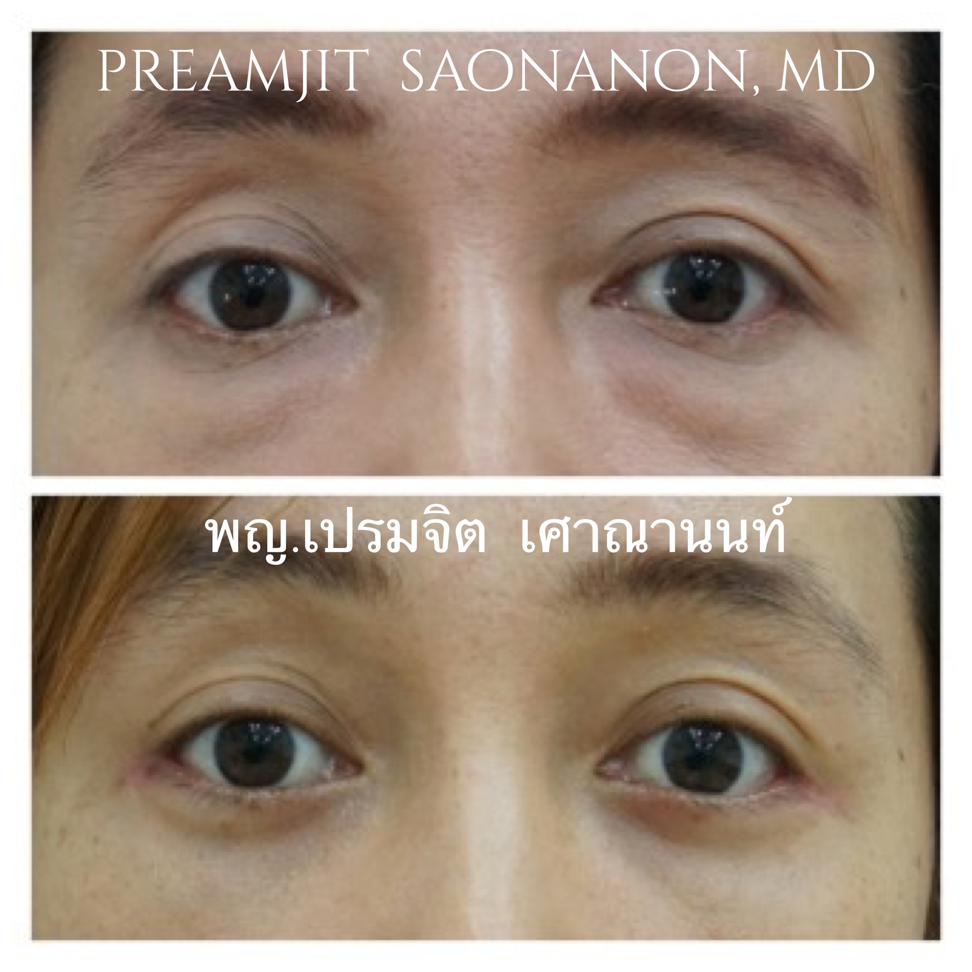 ผ่าตัดถุงใต้ตานูน
