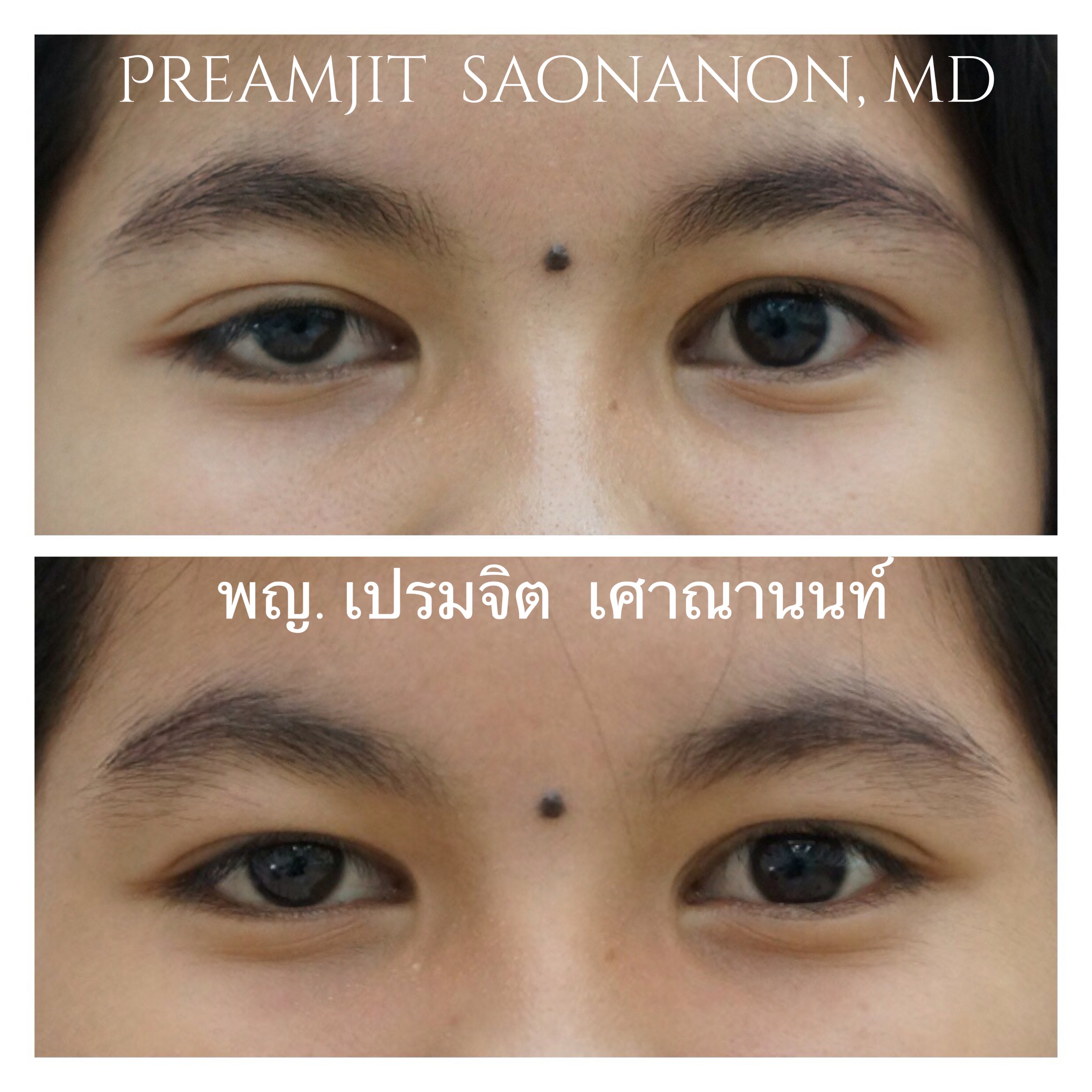 แก้หนังตาตกแต่กำเนิด