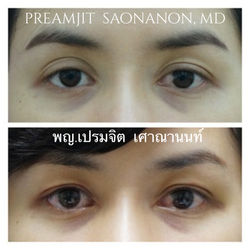 แก้ชั้นตาไม่เท่ากัน ตาปรือ