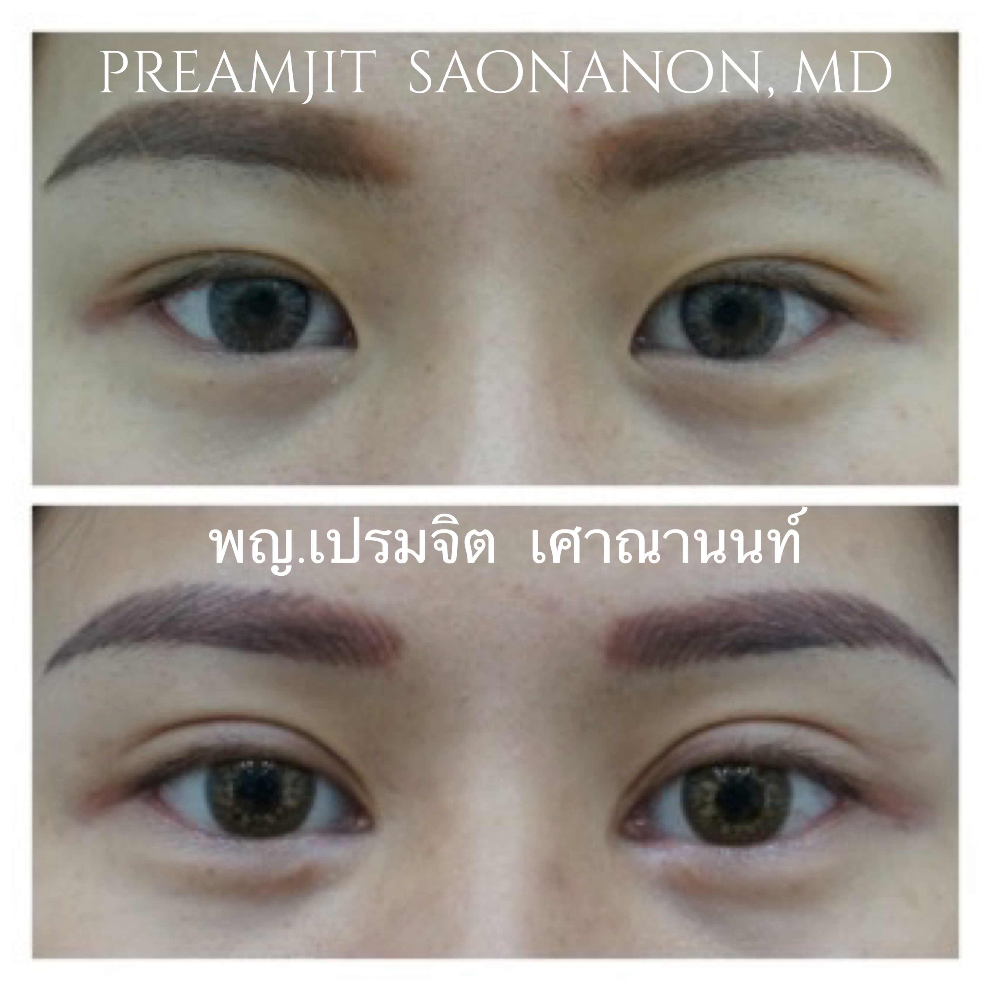 ทำตาสองชั้นเปิดหัวตา