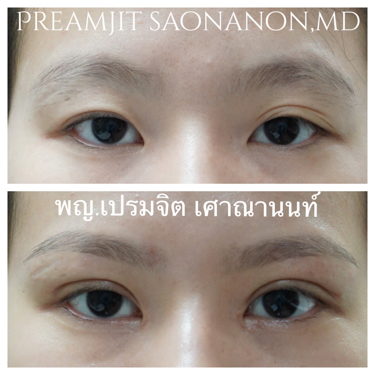 ทำตาสองชั้นเปิดหัวตา