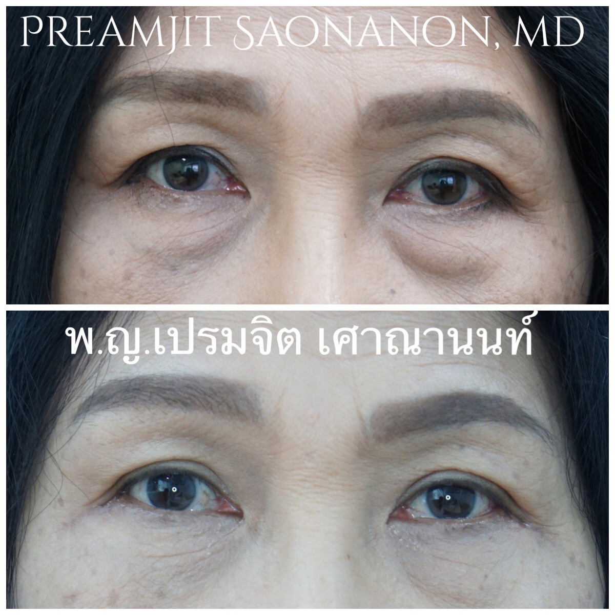 ผ่าตัดถุงใต้ตากรณีถุงใต้ตาใหญ่
