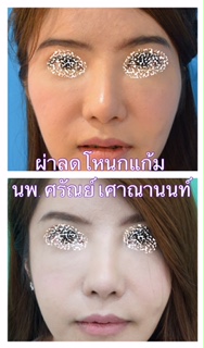 ผ่าตัดลดโหนกแก้ม