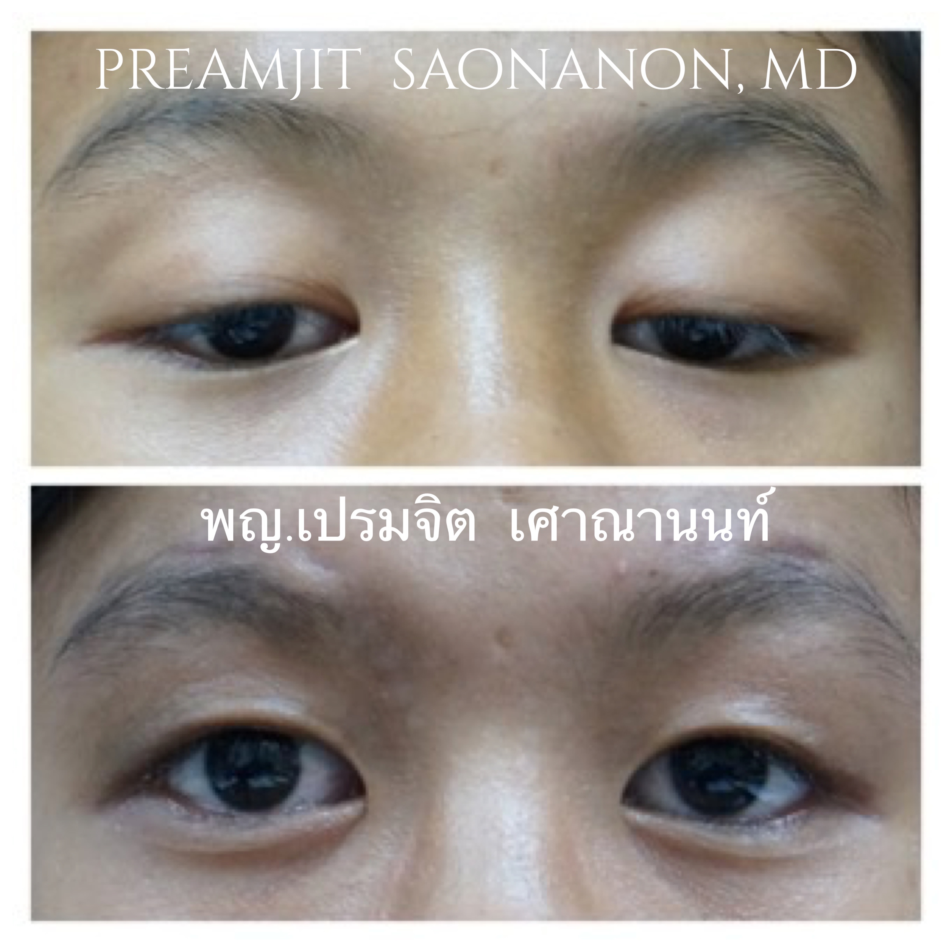 หนังตาตกแต่กำเนิด