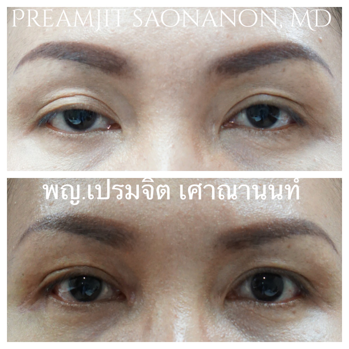 ตาไม่เท่ากัน
