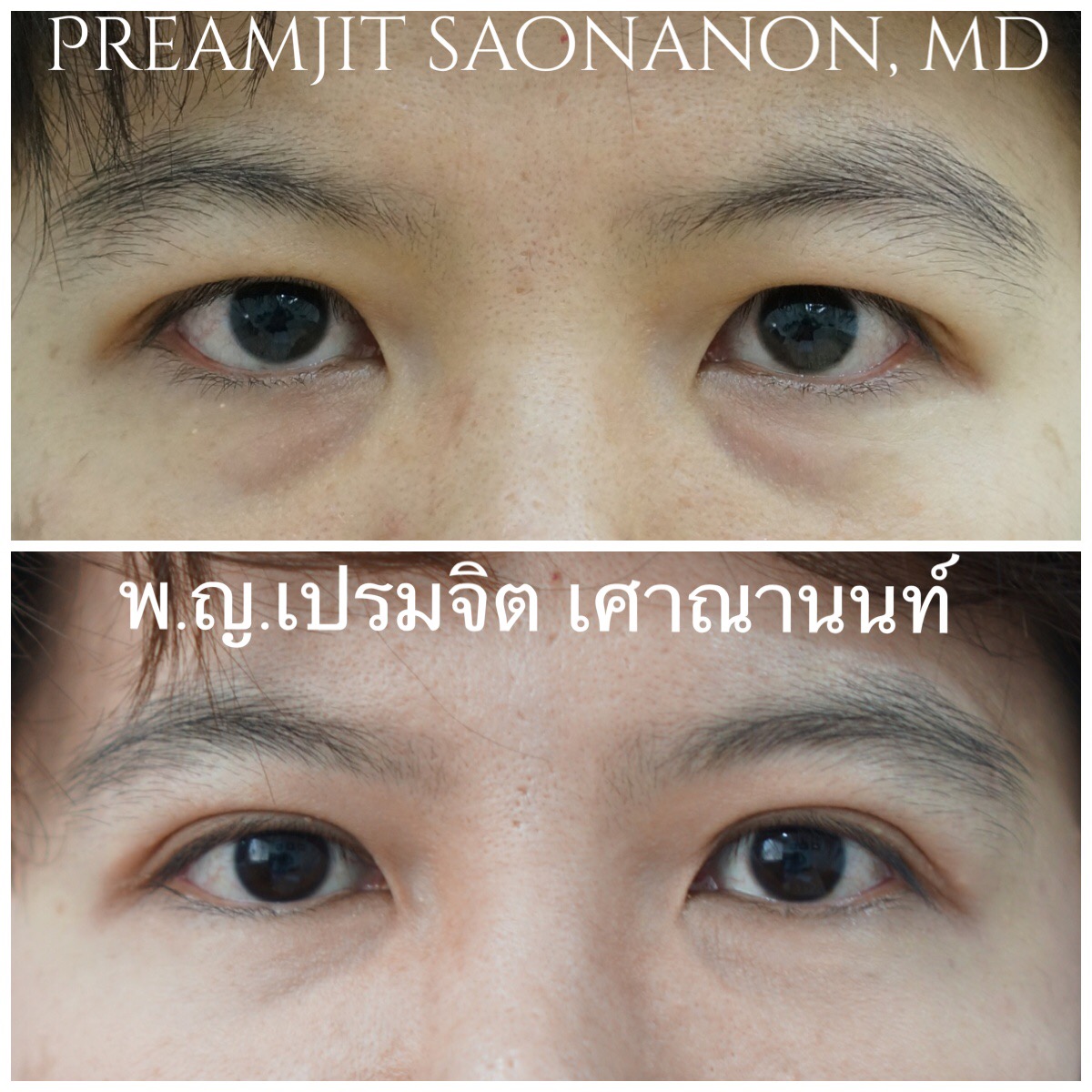 ผ่าตัดตาสองชั้นและถุงใต้ตา