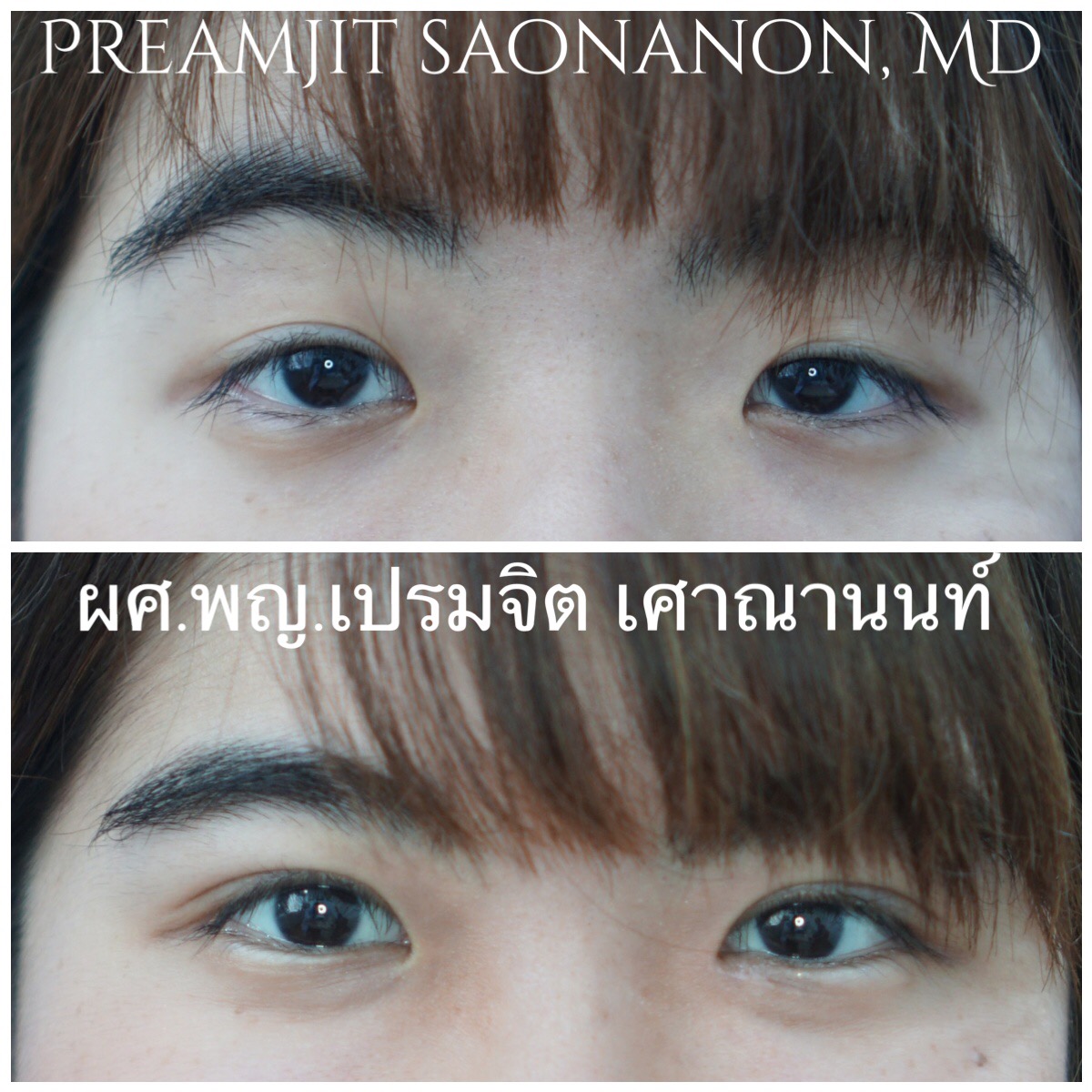 ตาสองชั้นสองข้าง เปิดหัวตาข้างซ้าย
