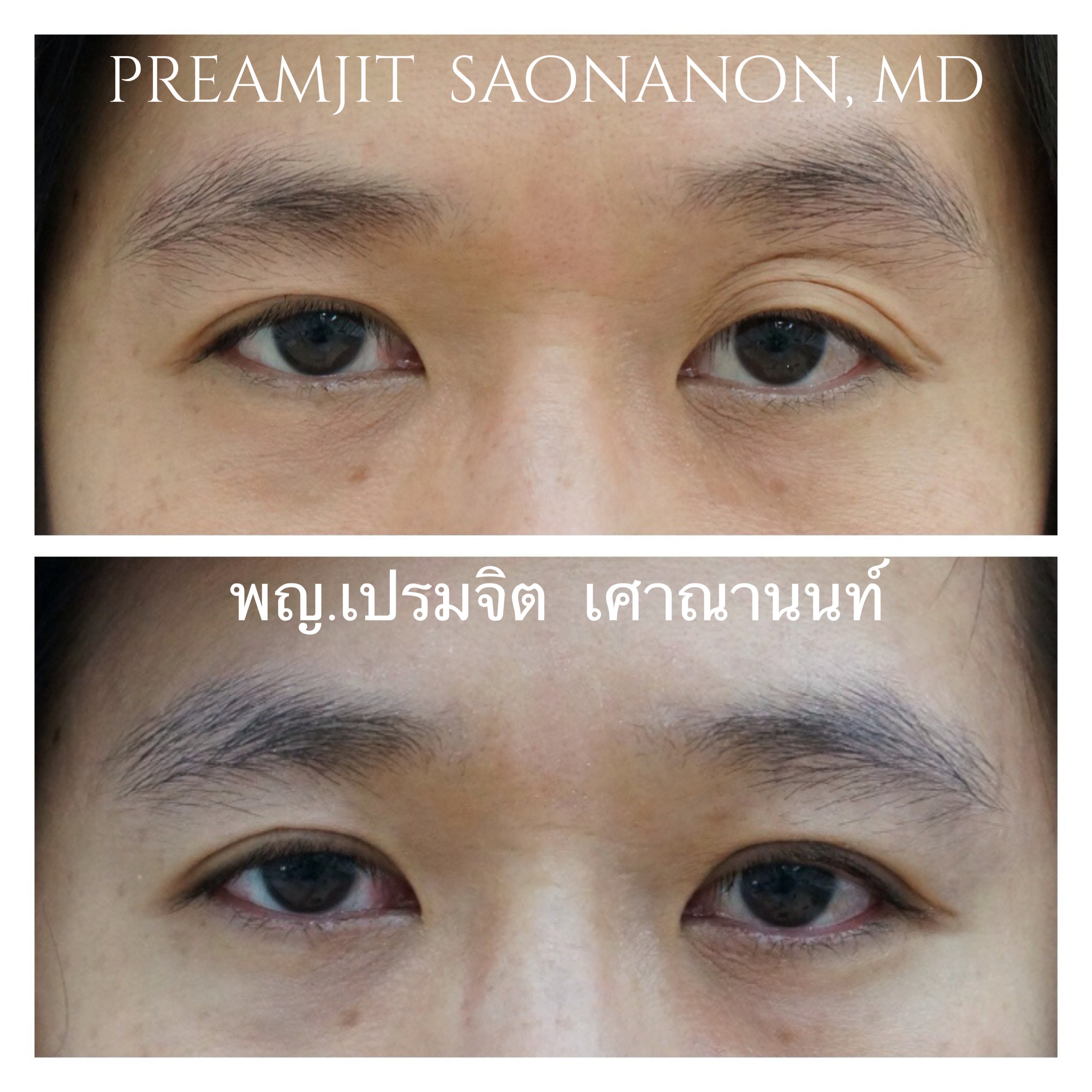แก้หนังตาตกหนึ่งข้าง