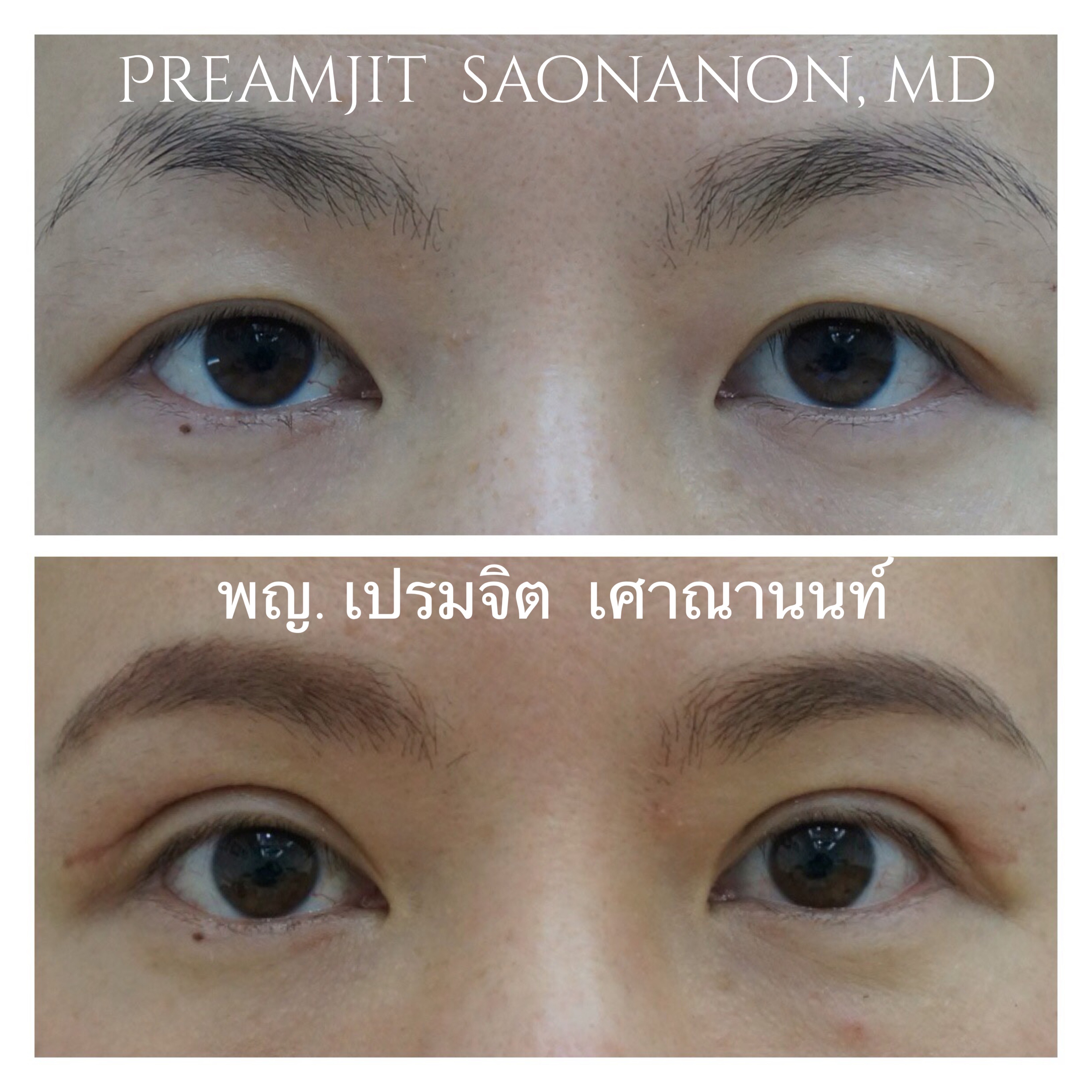 ผ่าตัดตาสองชั้นหางตาตก