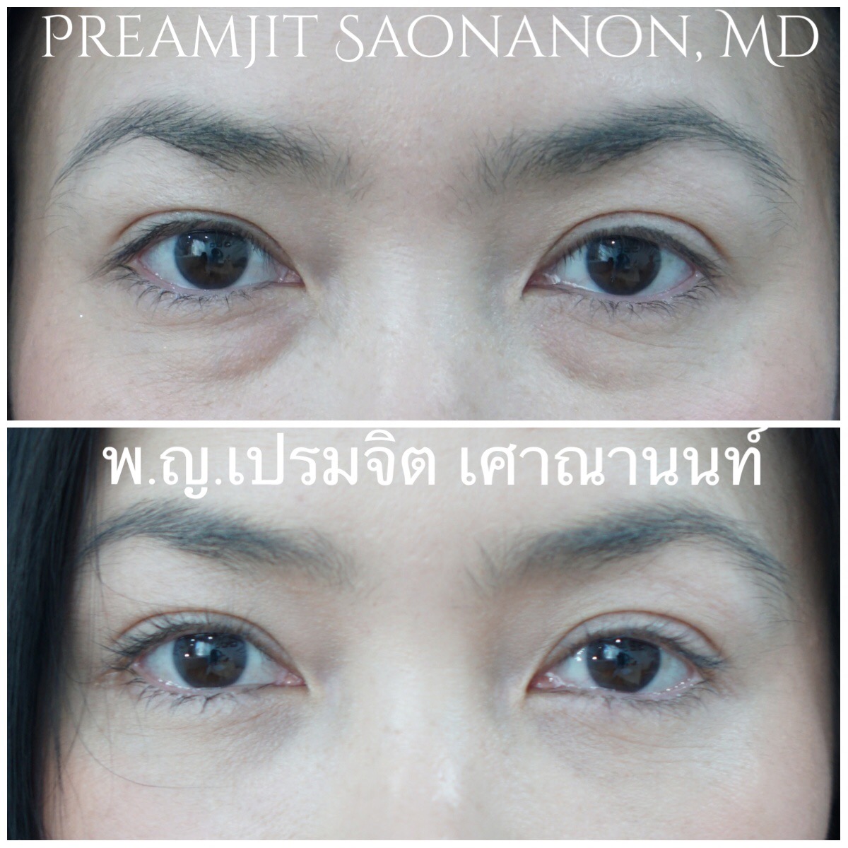 ผ่าตัดถุงใต้ตา ย้ายไขมัน