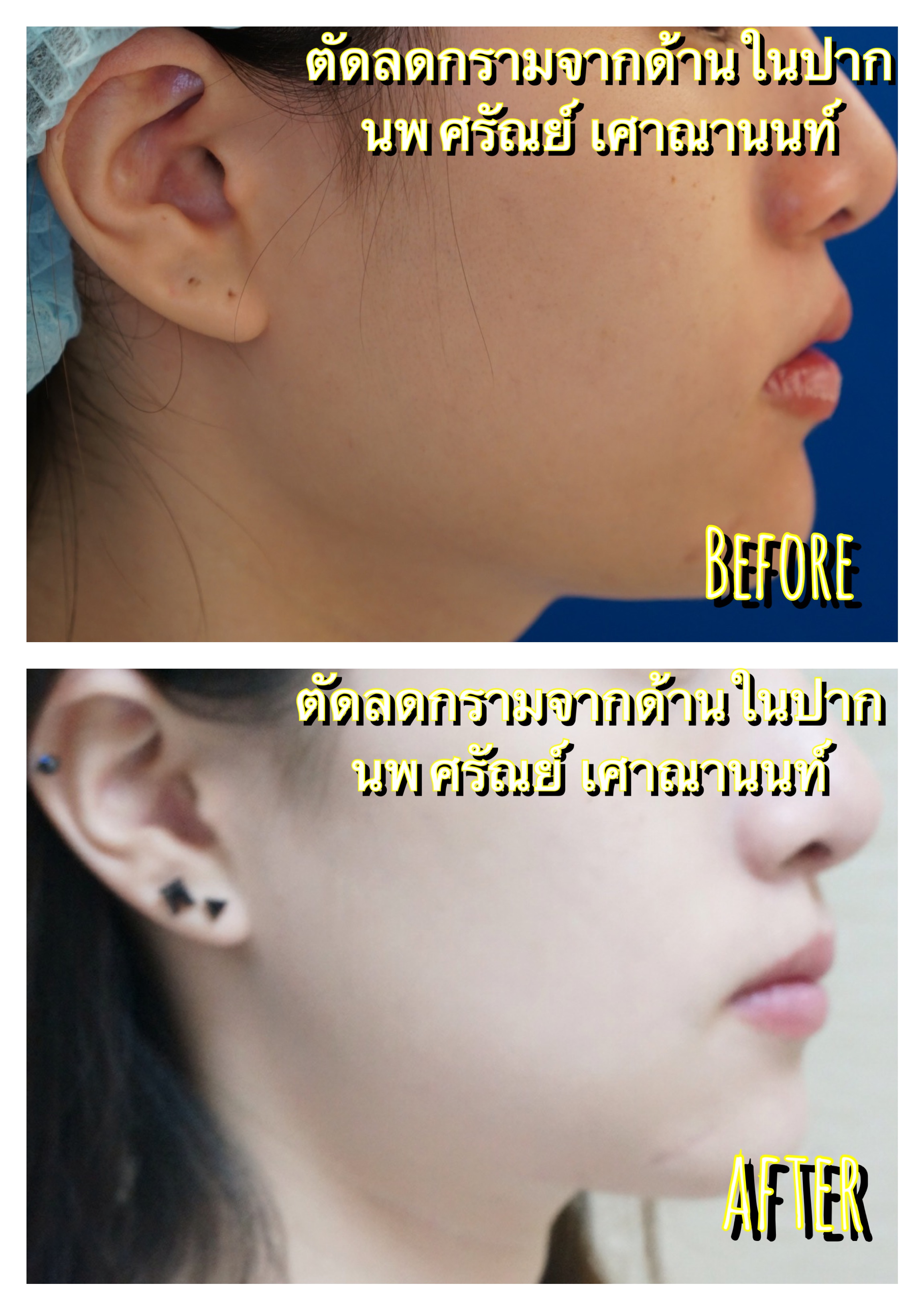 ตัดมุมกราม
