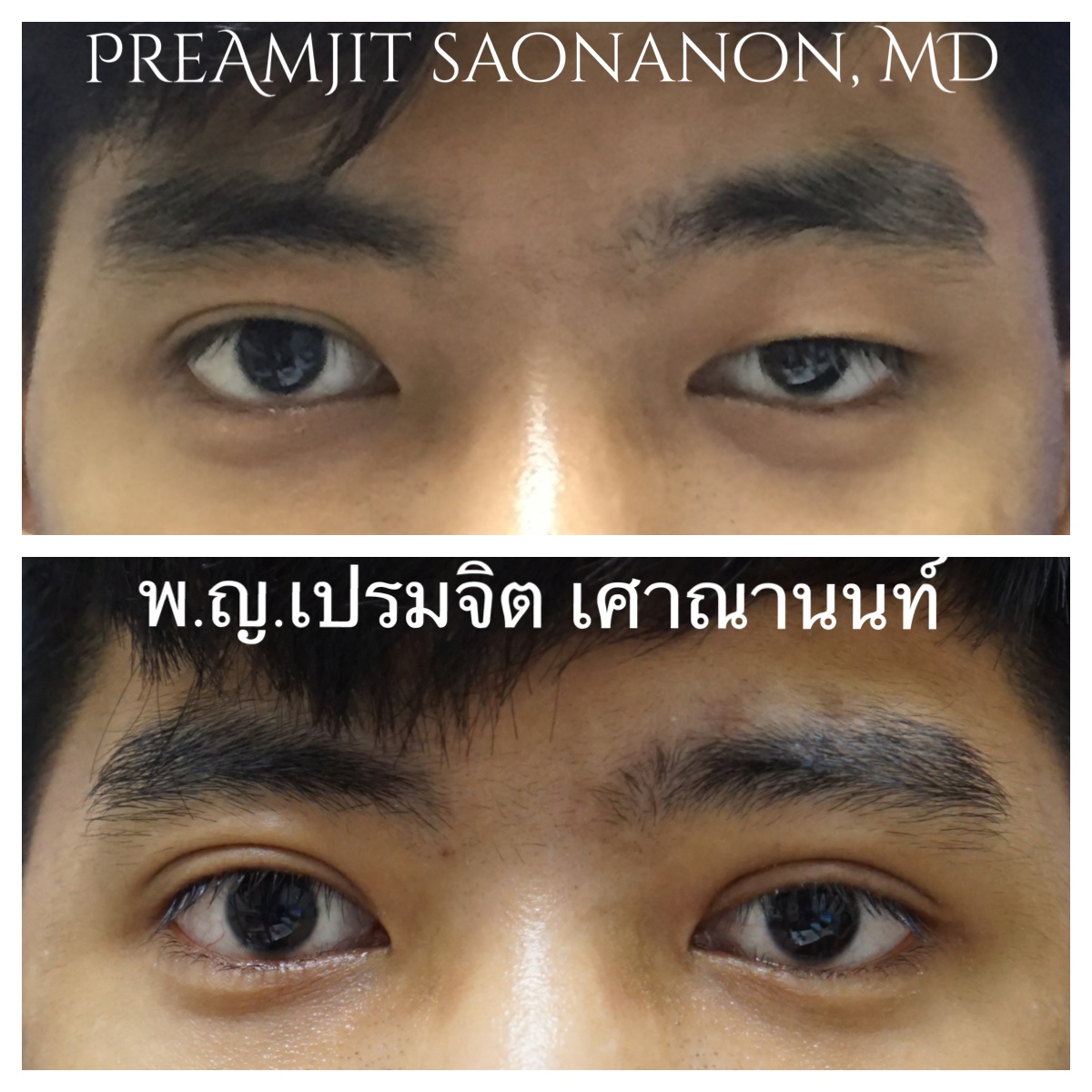 หนังตาตกแต่เกิด