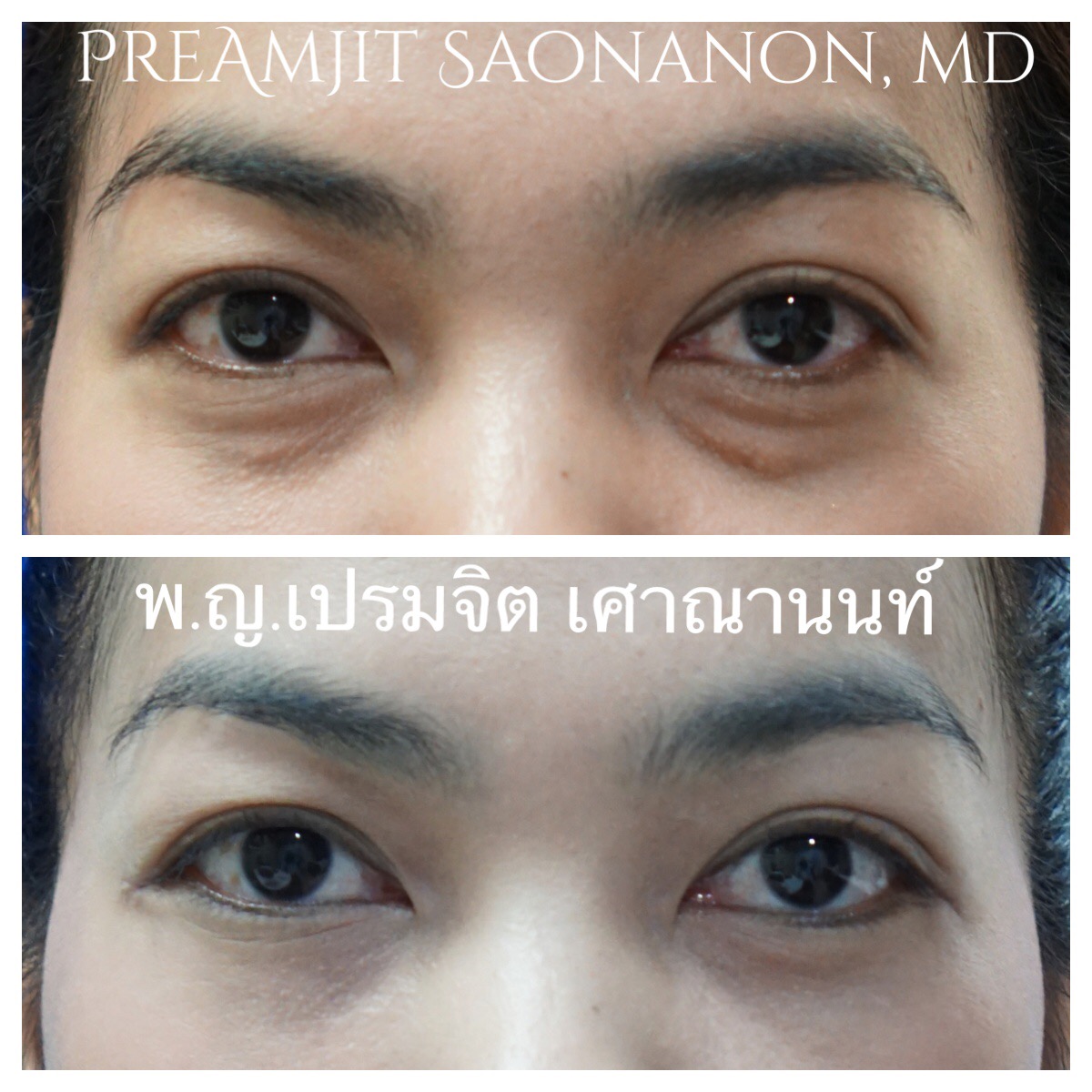 ผ่าตัดถุงใต้ตาทางเยื่อบุตาและย้ายไขมัน