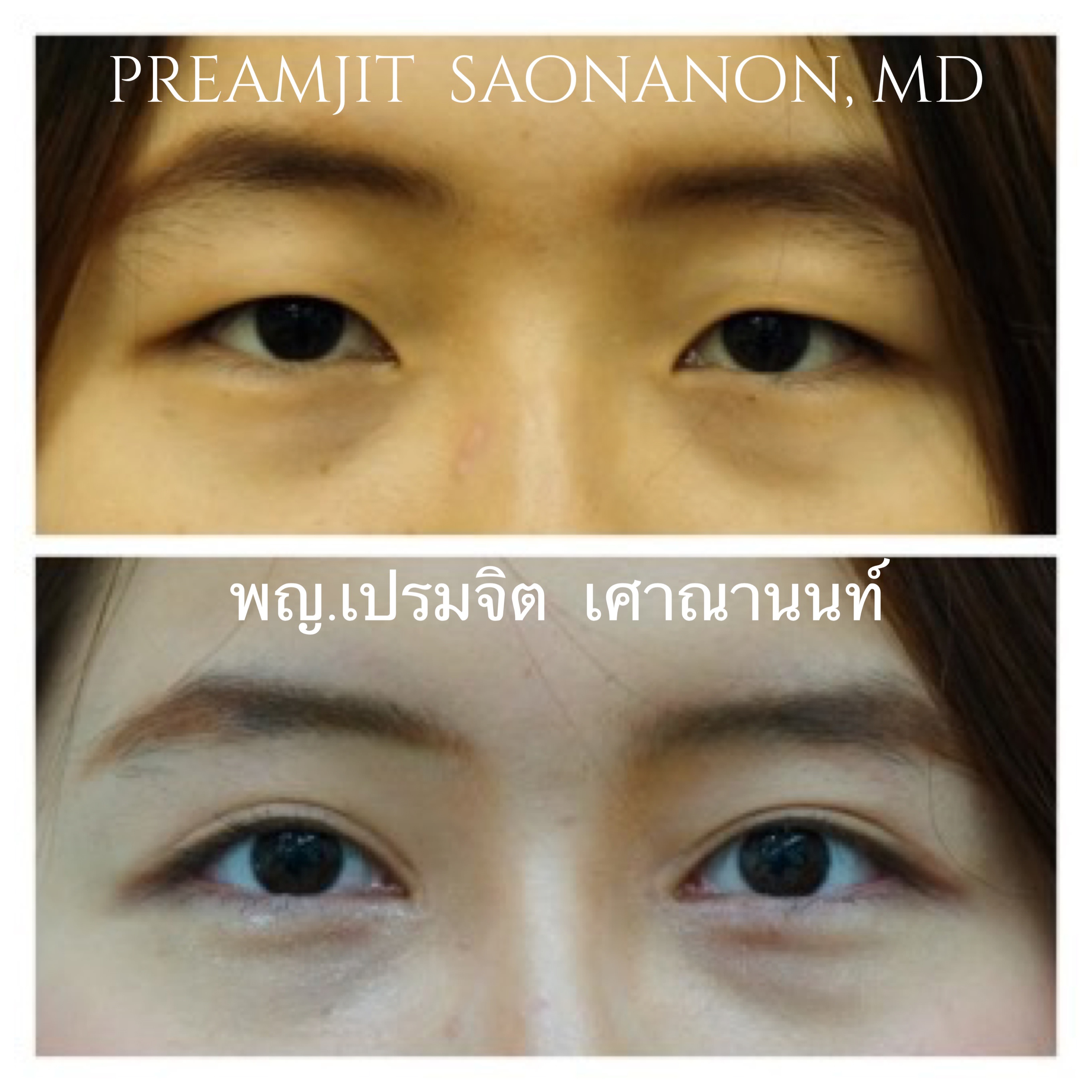ทำตาสองชั้นเปิดหัวตา