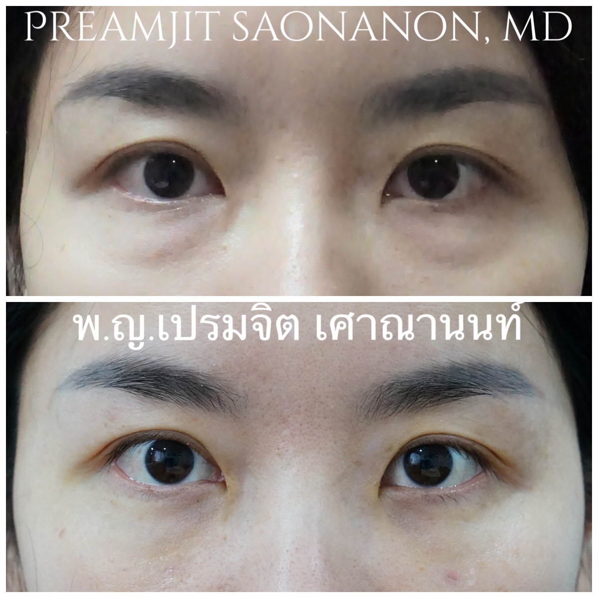 ผ่าตัดถุงใต้ตาทางเยื่อบุตาและย้ายไขมัน
