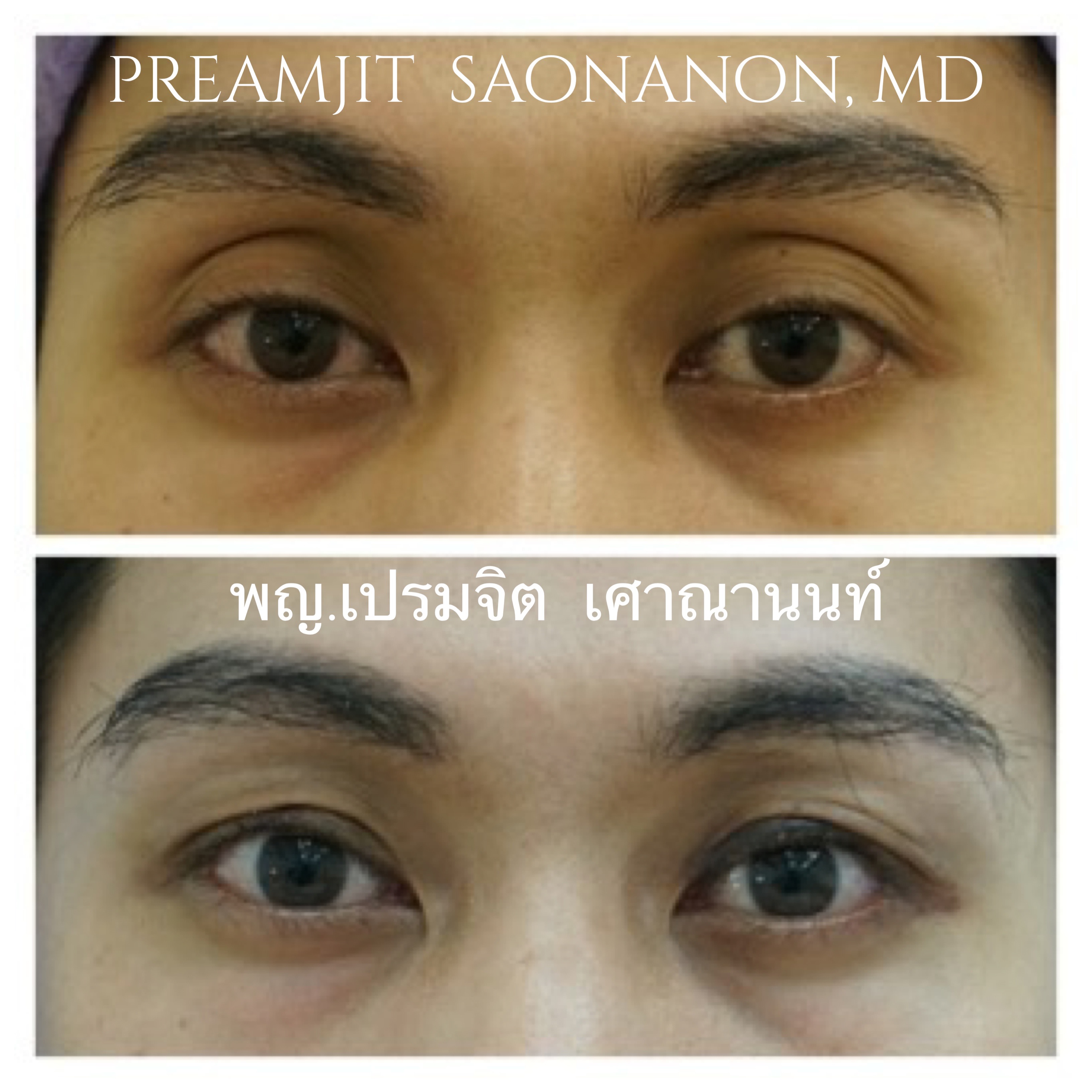 ตาโหล กระบอกตาลึก