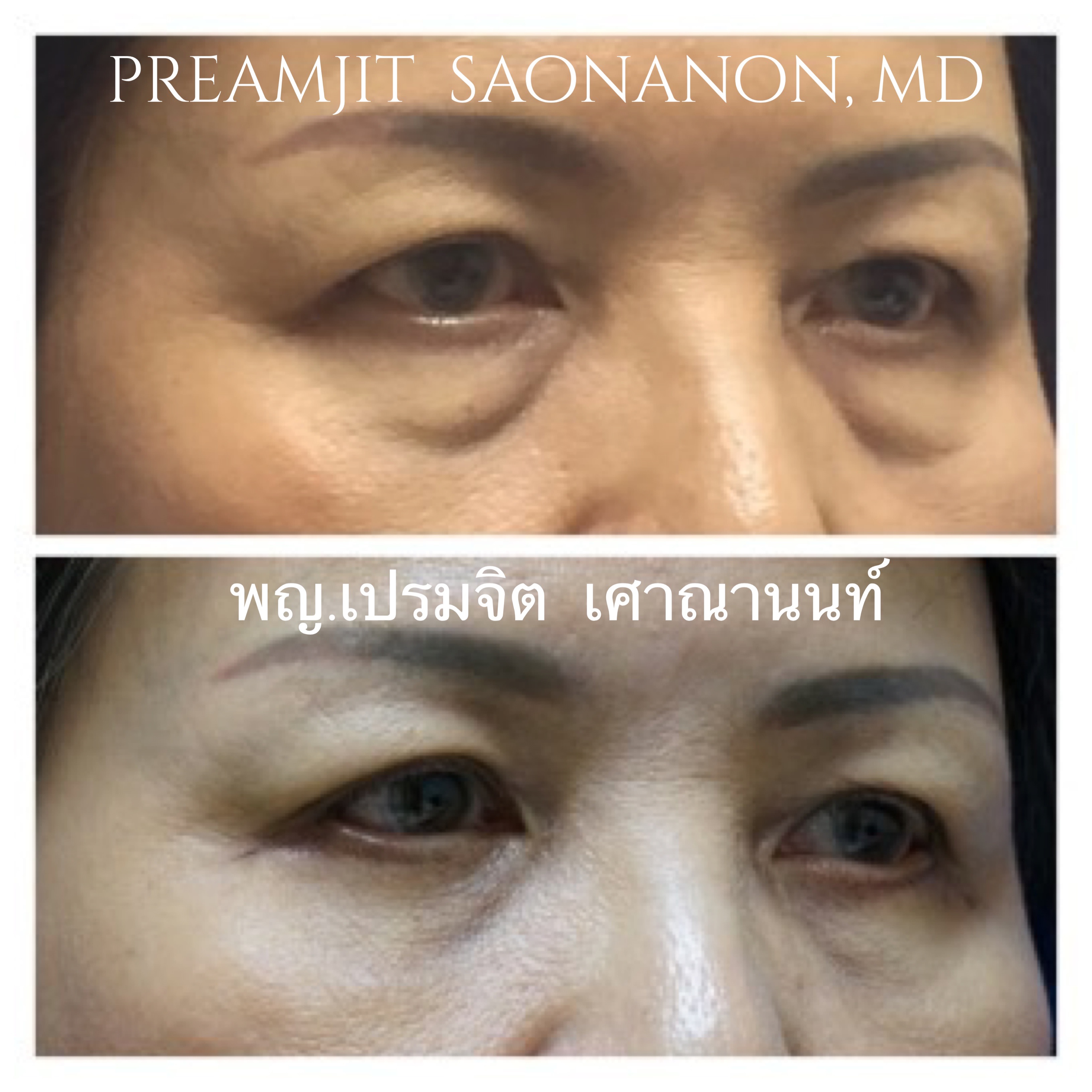ผ่าตัดถุงใต้ตา