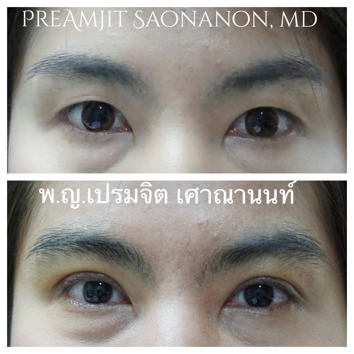 ผ่าตัดตาสองชั้นแผลเล็ก