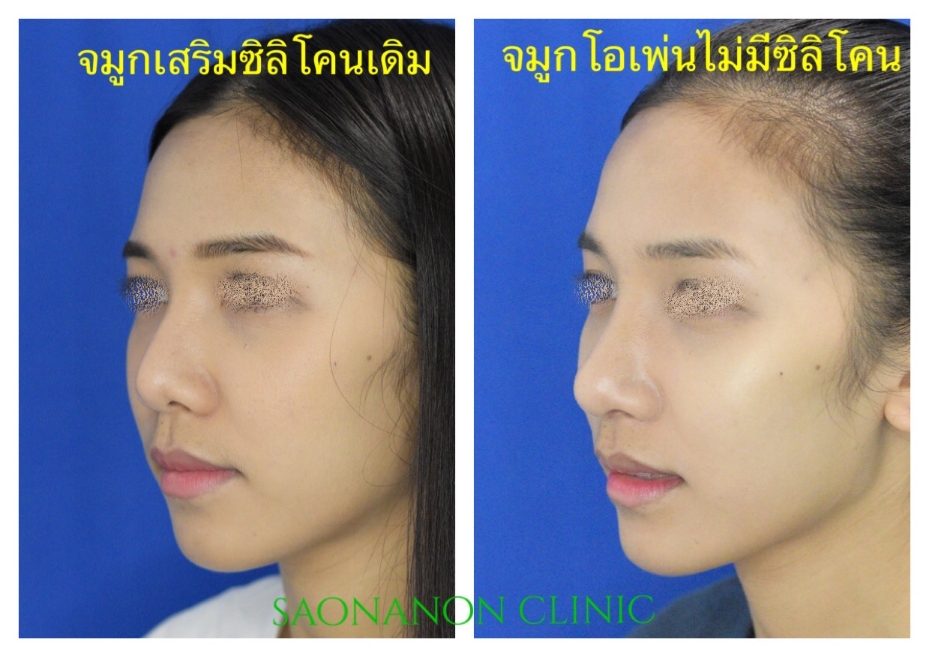 แก้ปลายสั้น