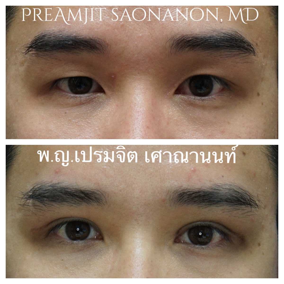 ผ่าตาสองชั้นในผู้ชาย