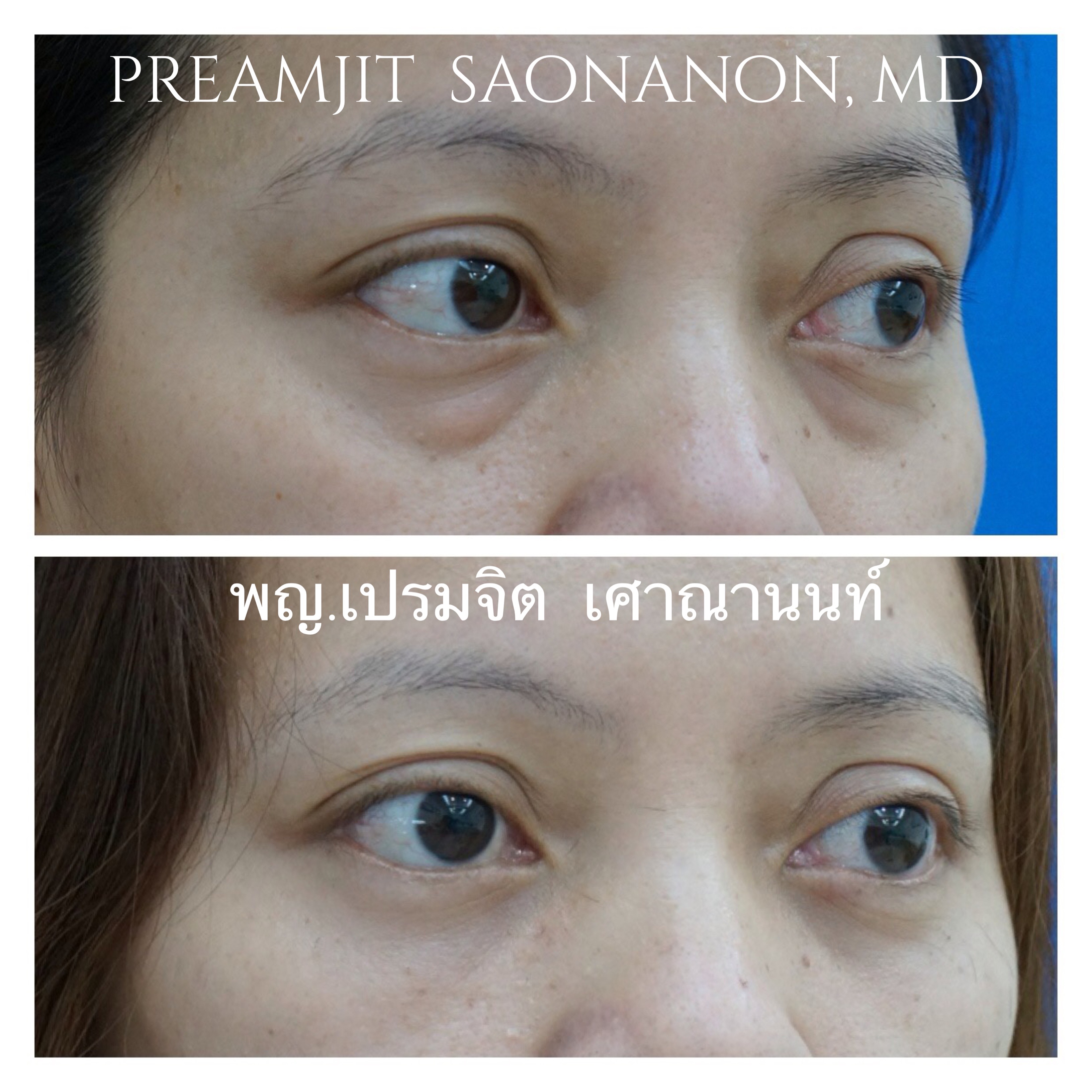 ผ่าตัดแก้ไขถุงใต้ตา