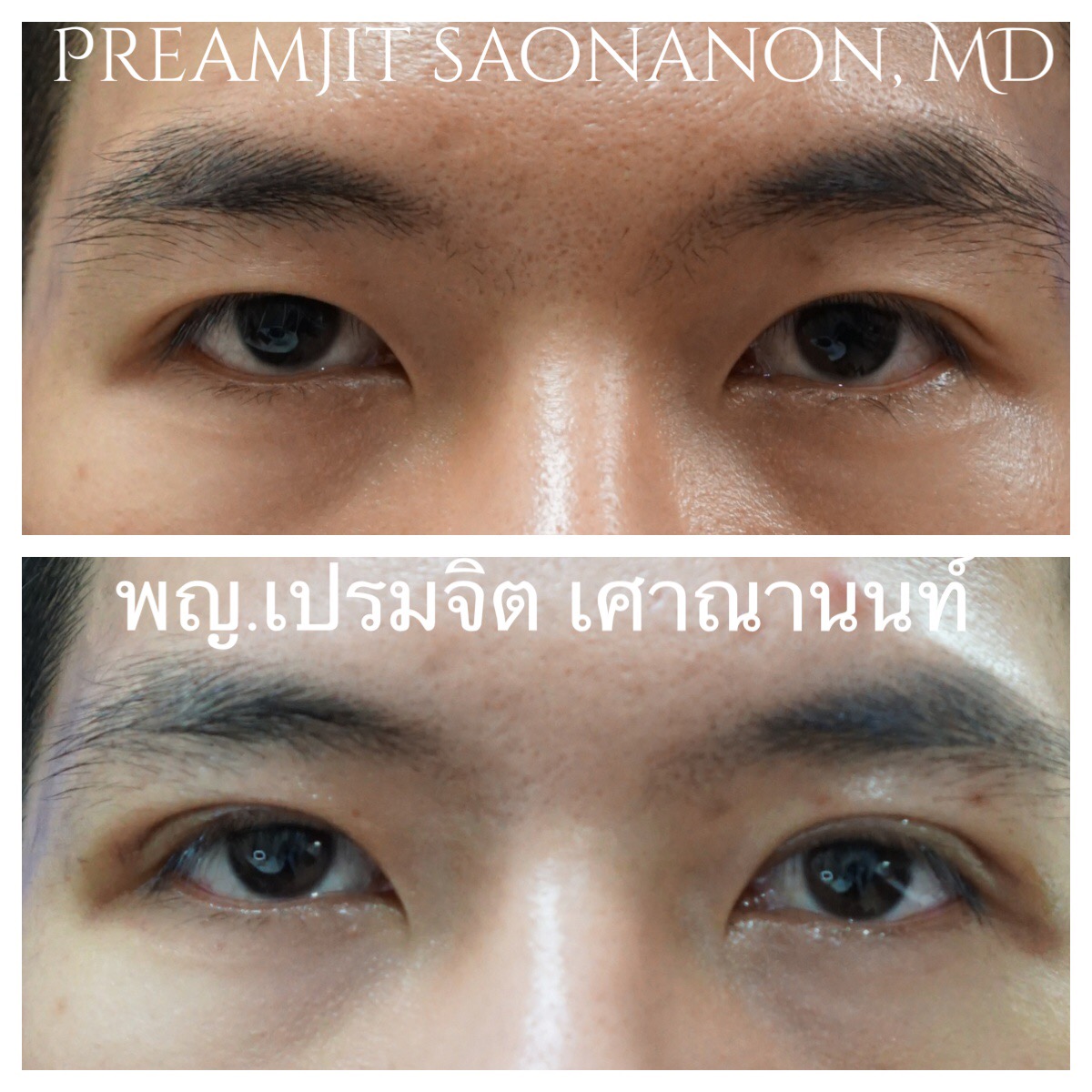 ผ่าตัดตาสองชั้น