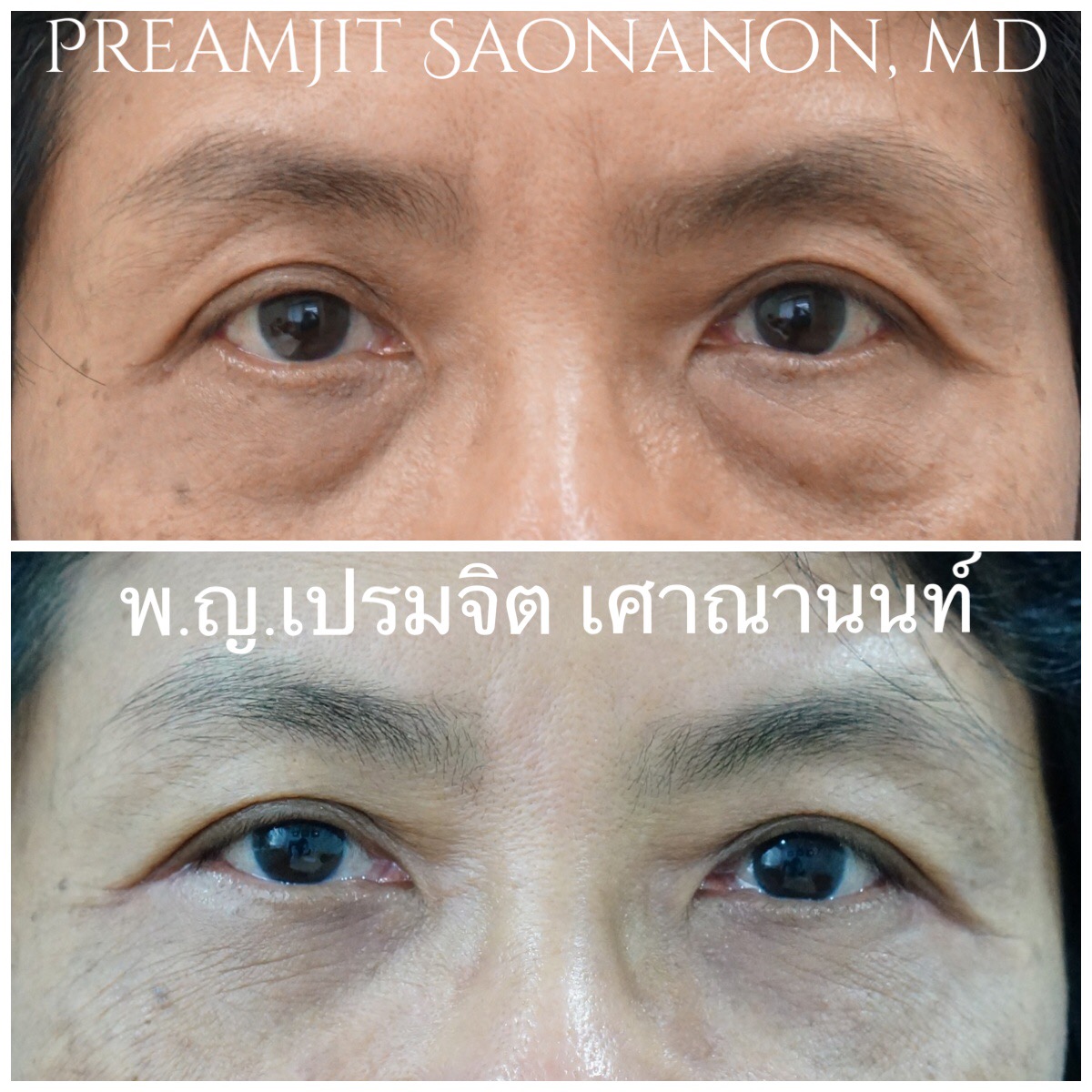 ผ่าตัดถุงใต้ตาและย้ายไขมันใต้ตา