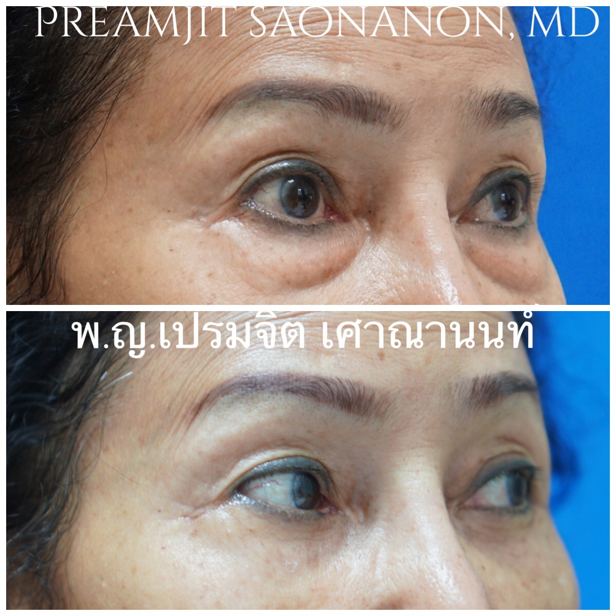 ผ่าตัดถุงใต้ตากรณีถุงใต้ตาใหญ่