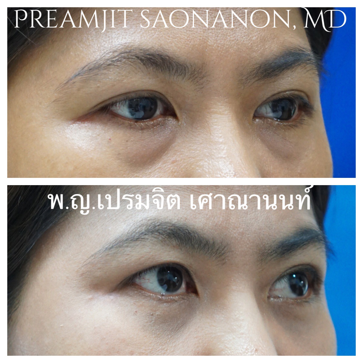ผ่าตัดถุงใต้ตาและย้ายไขมัน