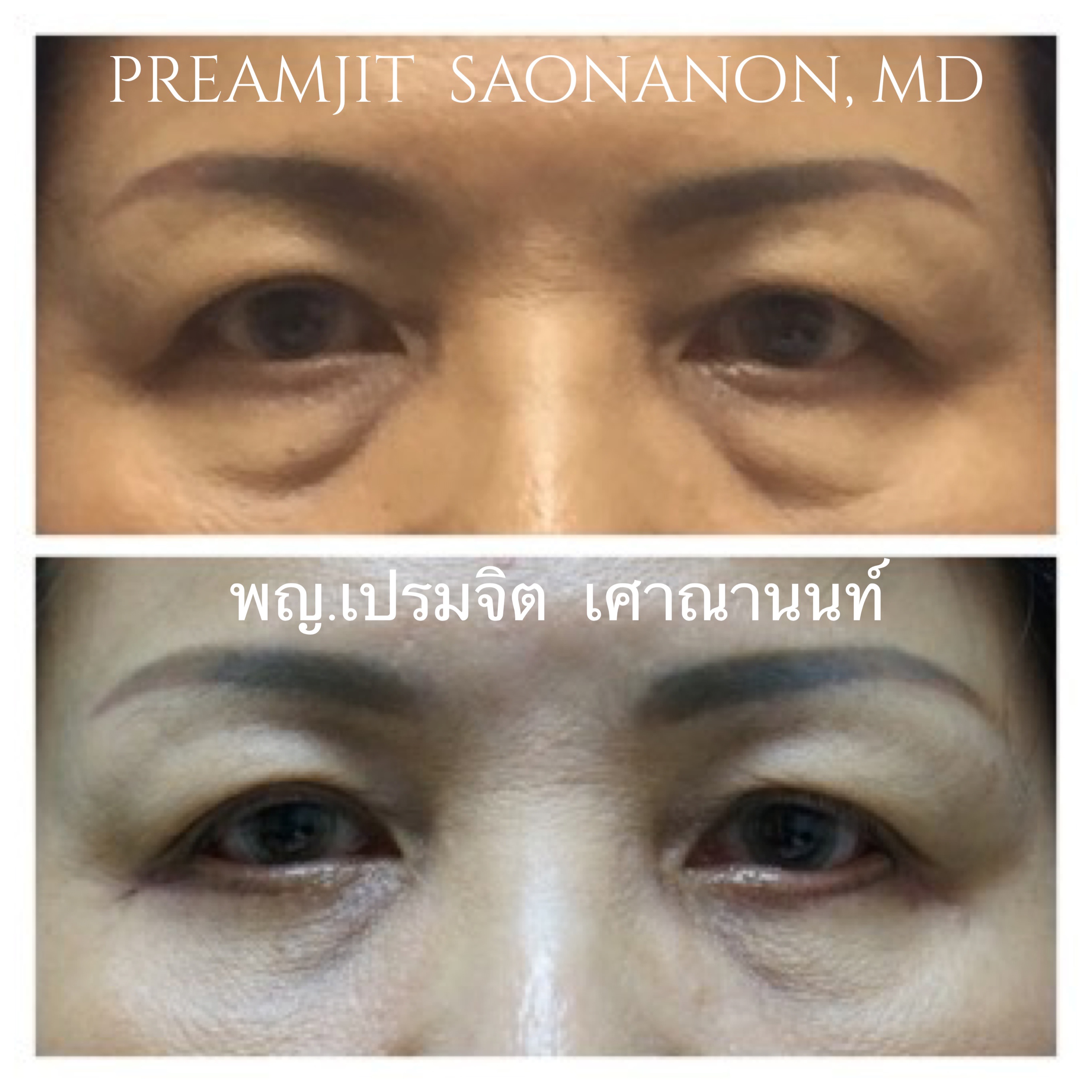 ผ่าตัดถุงใต้ตา