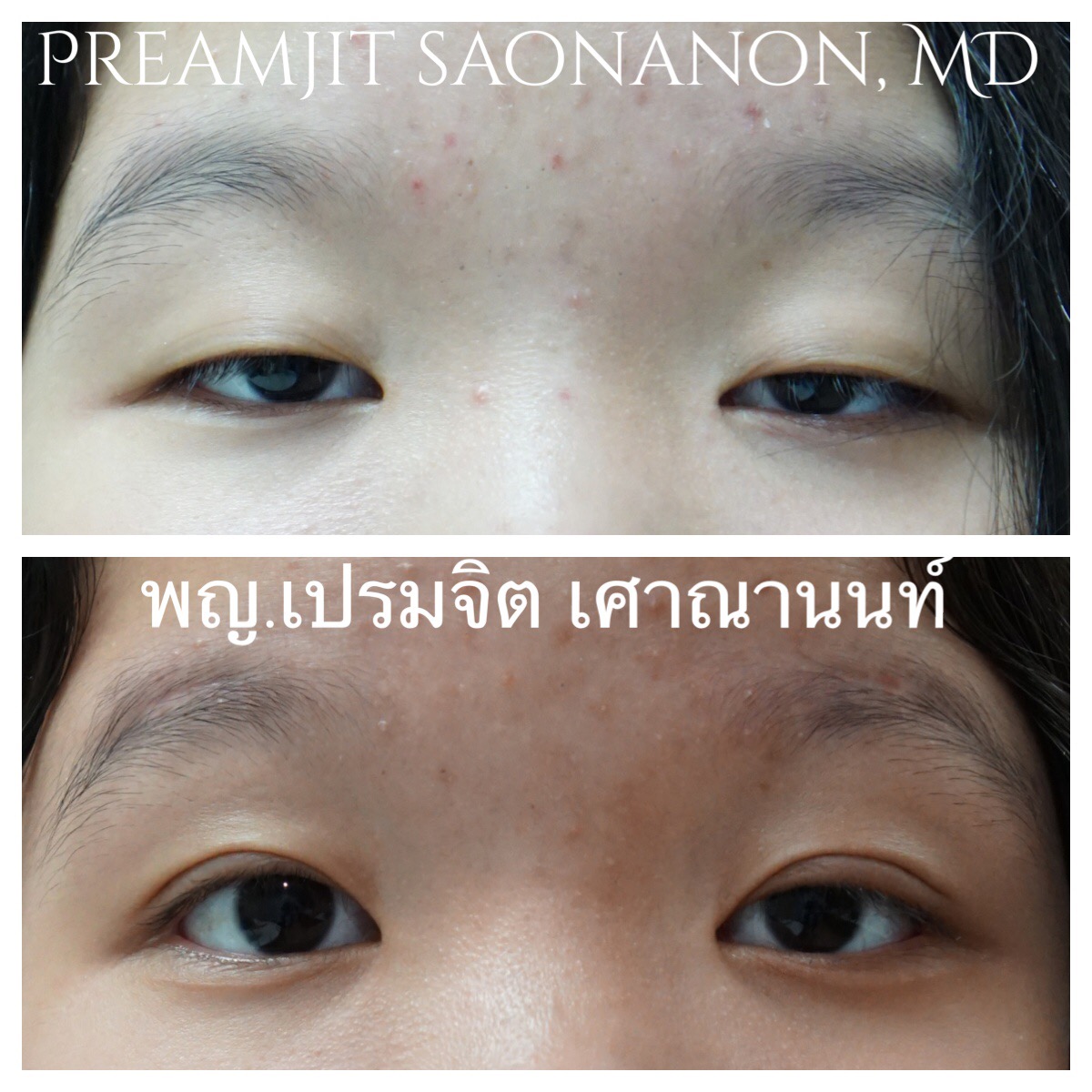 หนังตาตกแต่เกิดทั้งสองข้าง