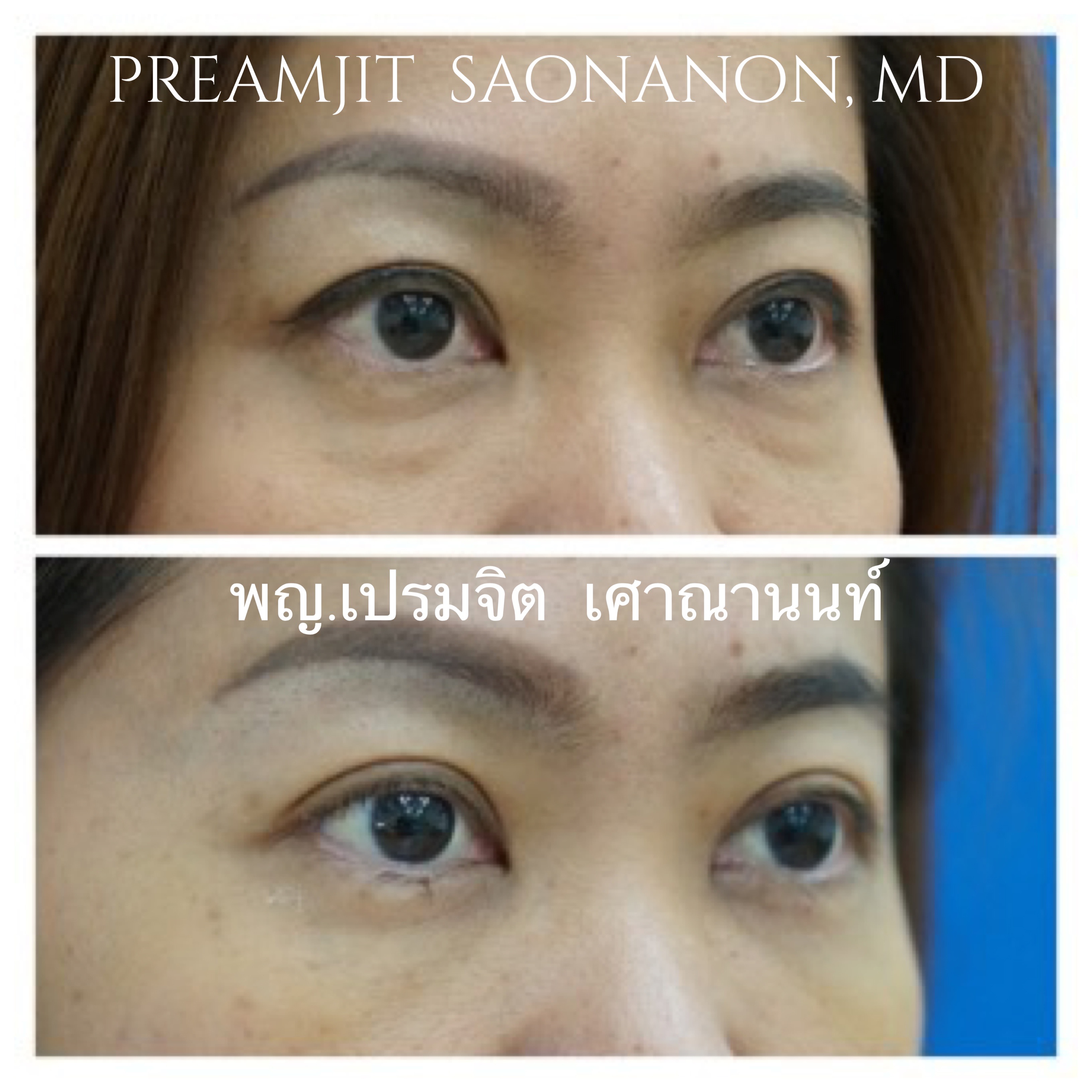 ผ่าตัดถุงใต้ตา