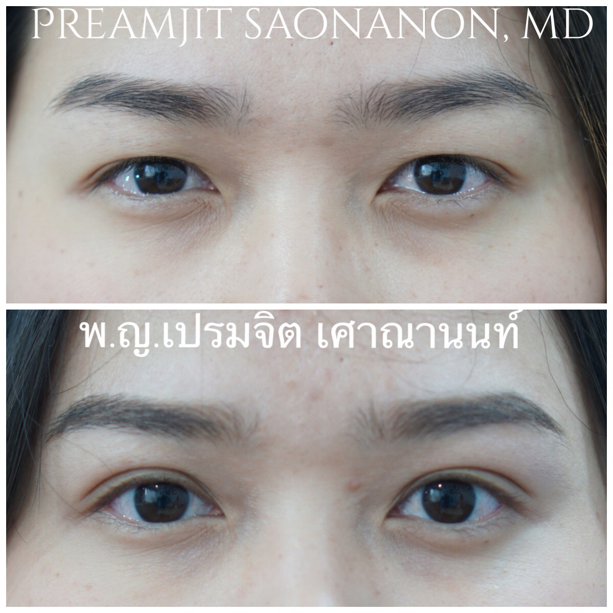 ผ่าตัดตาสองชั้น