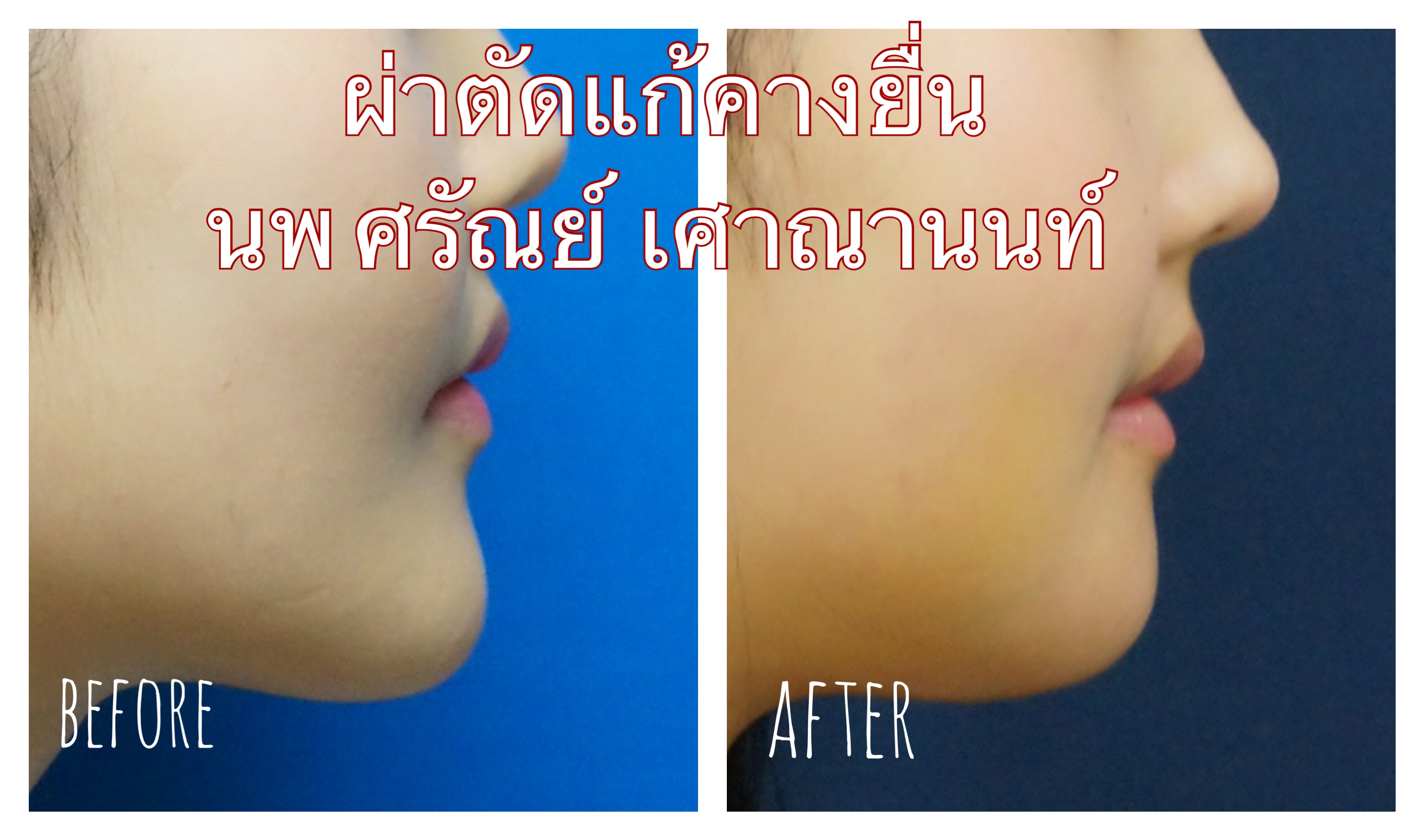 ผ่าเลื่อนคางแก้คางยื่น