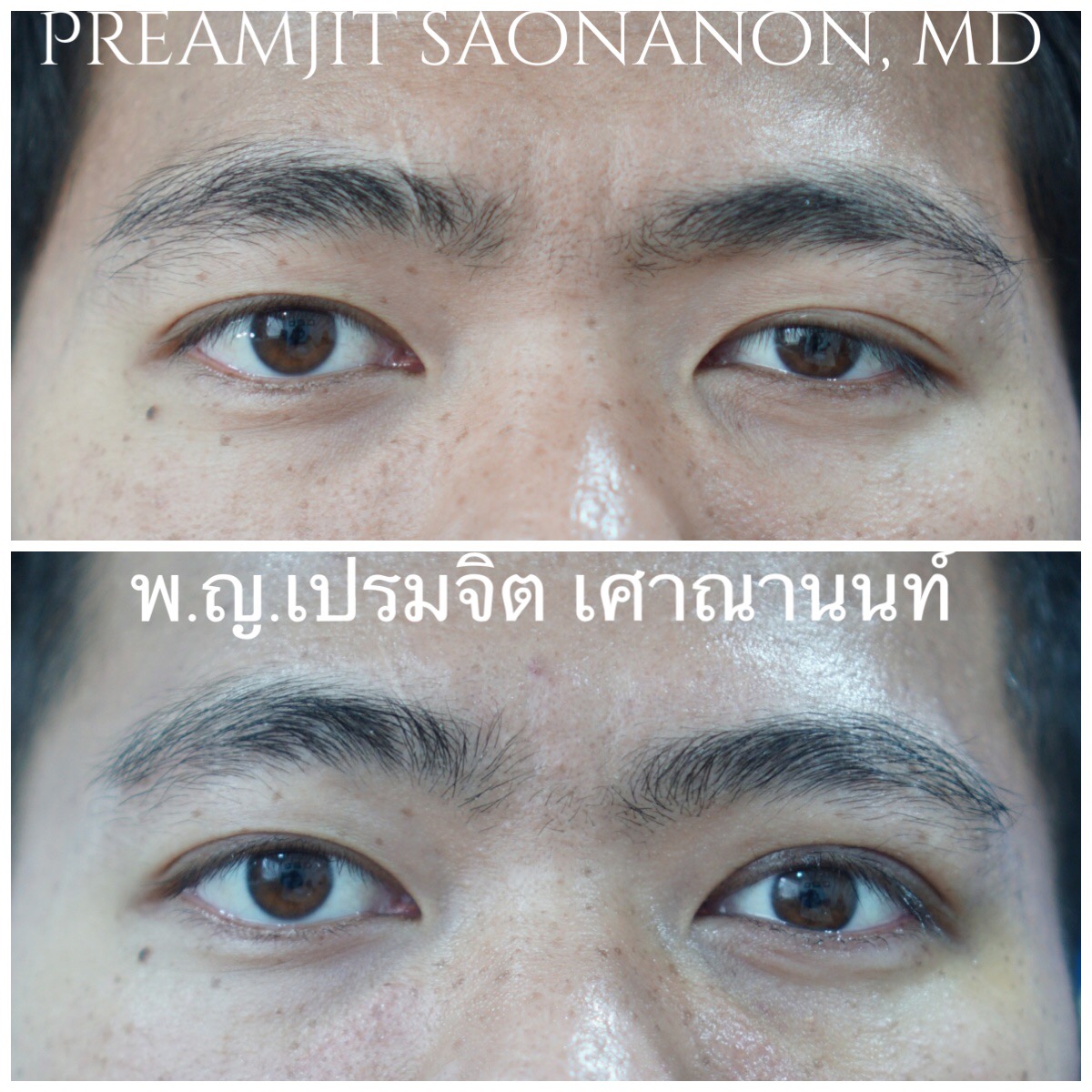 หนังตาตกแต่กำเนิดข้างซ้าย