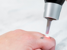 כל מה שחשוב לדעת על טיפולי הסרת קעקועים