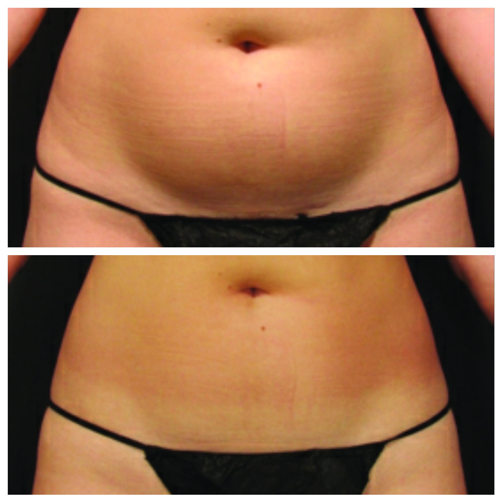 Ultrashape for body contouring