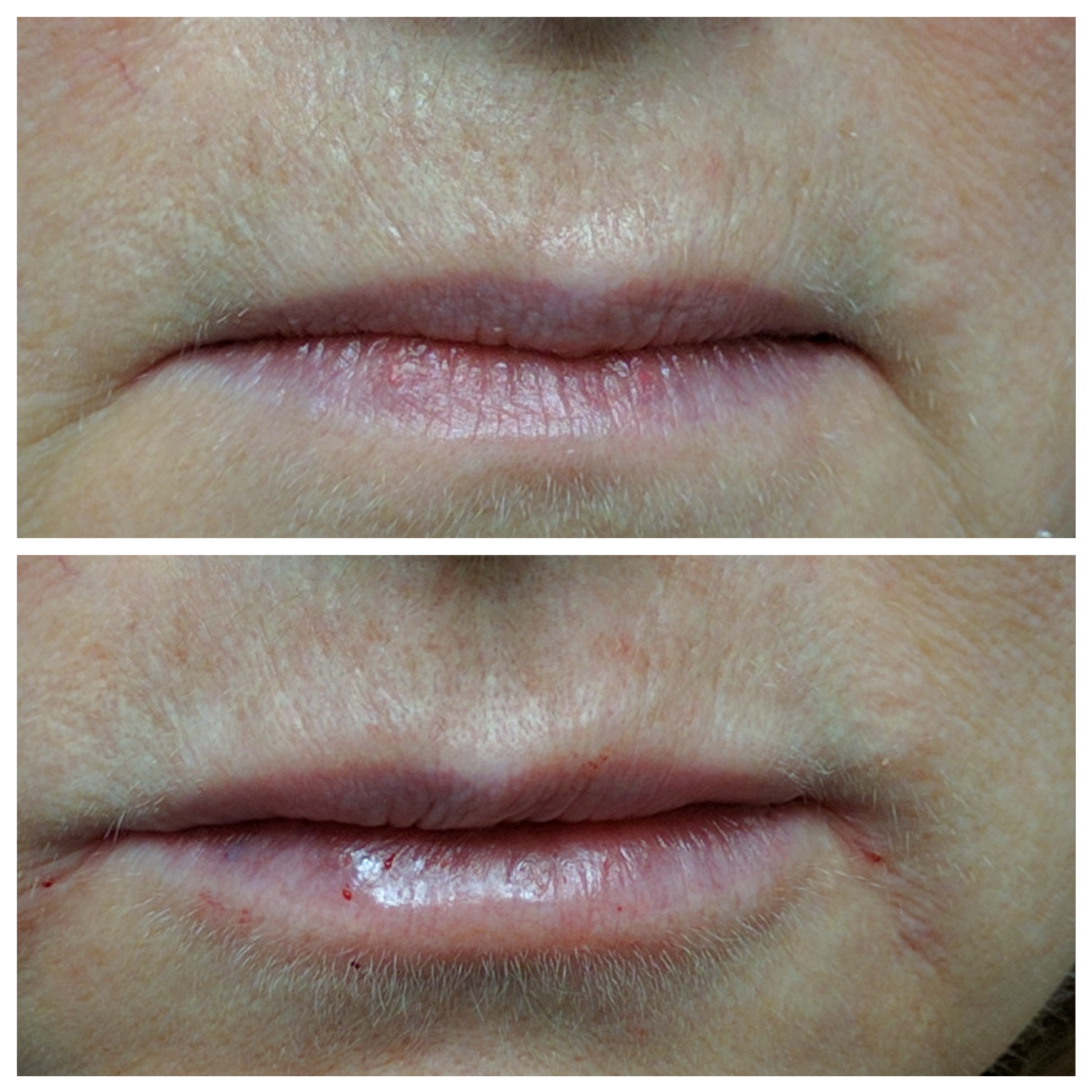 Fillers for natural lips