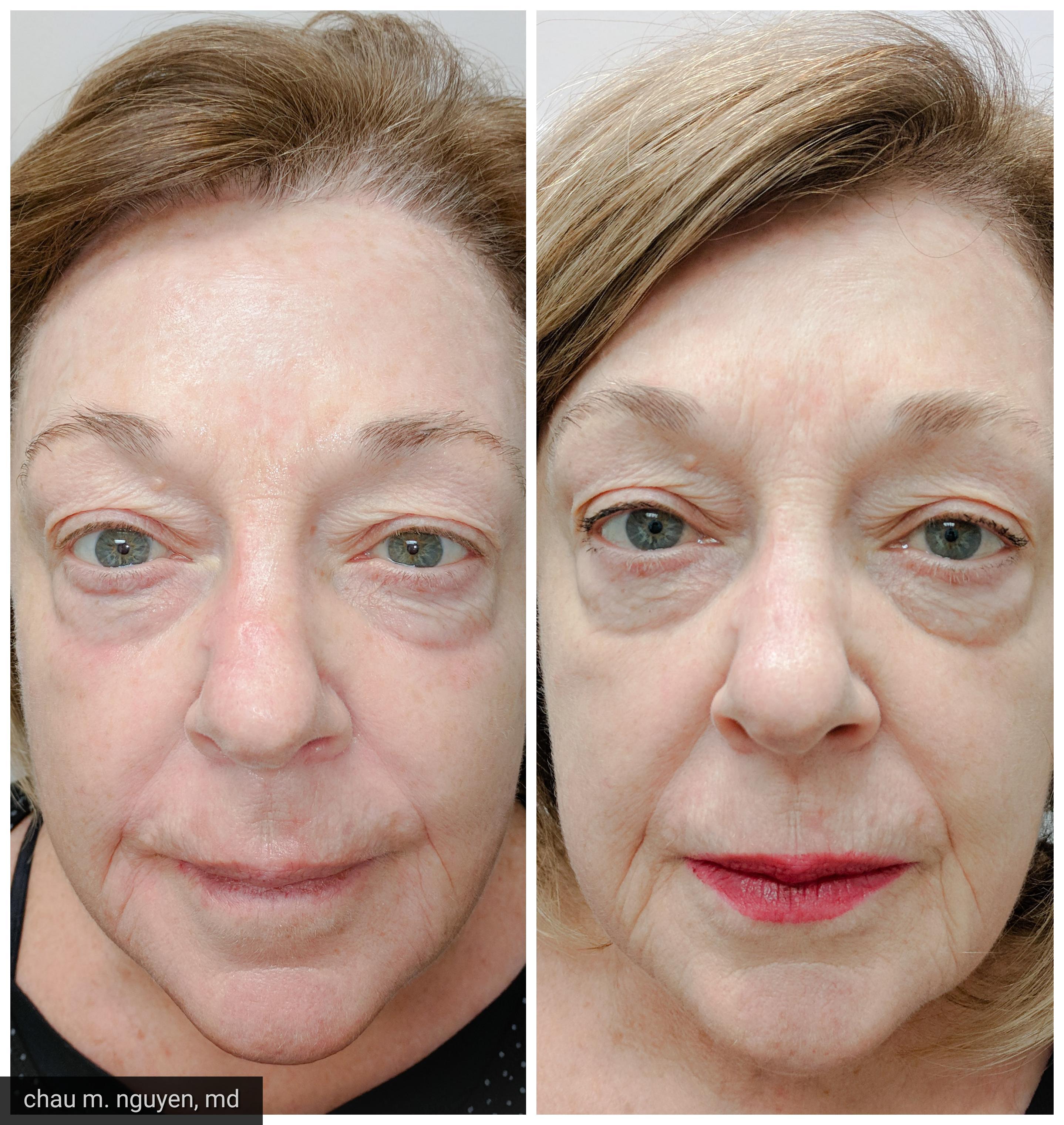 Fractora rejuvenation